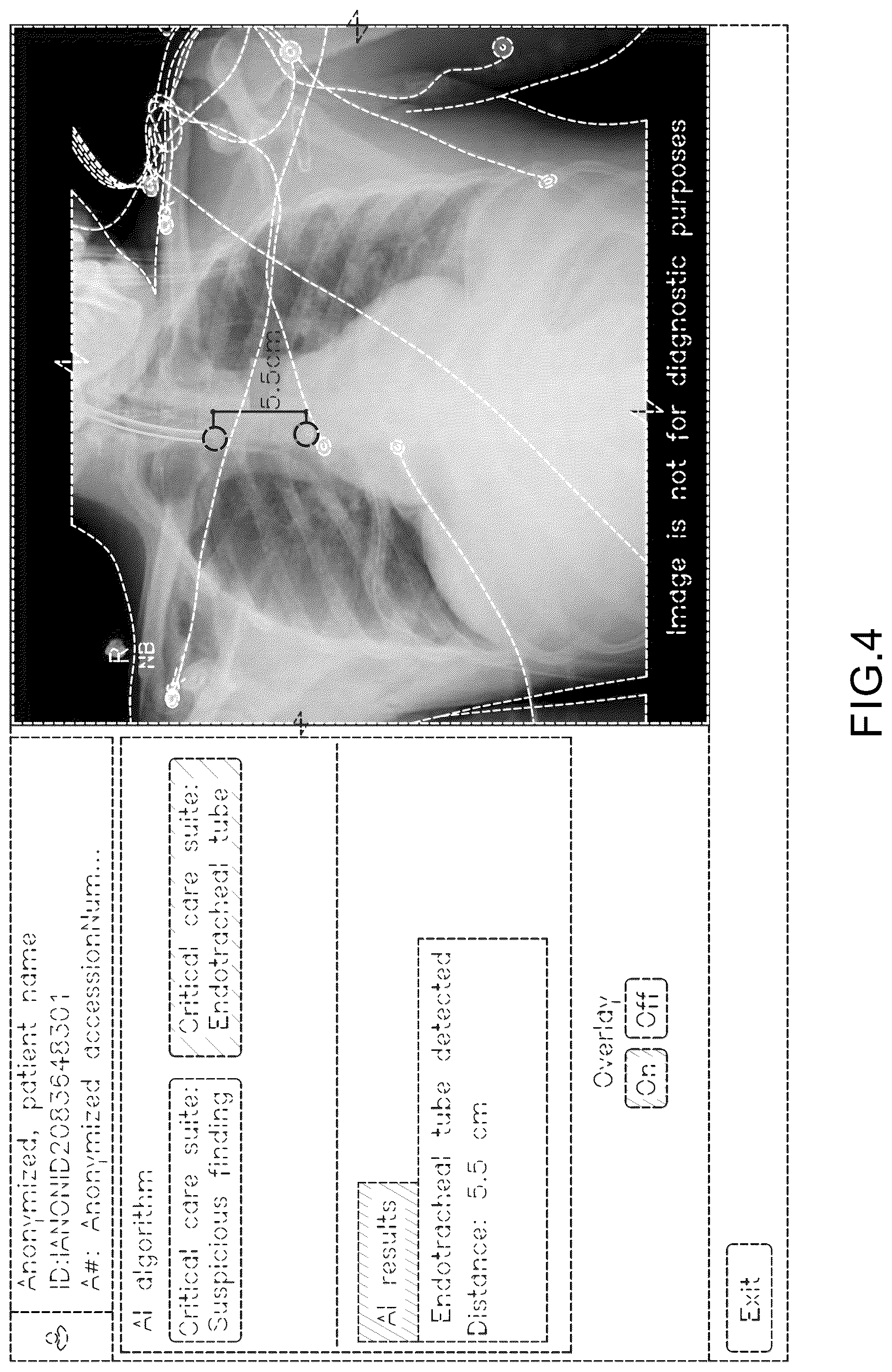 Patent USD1077854 Figure 4 – Display screen or portion thereof with a computer generated graphical user interface for placement of a medical tube or line