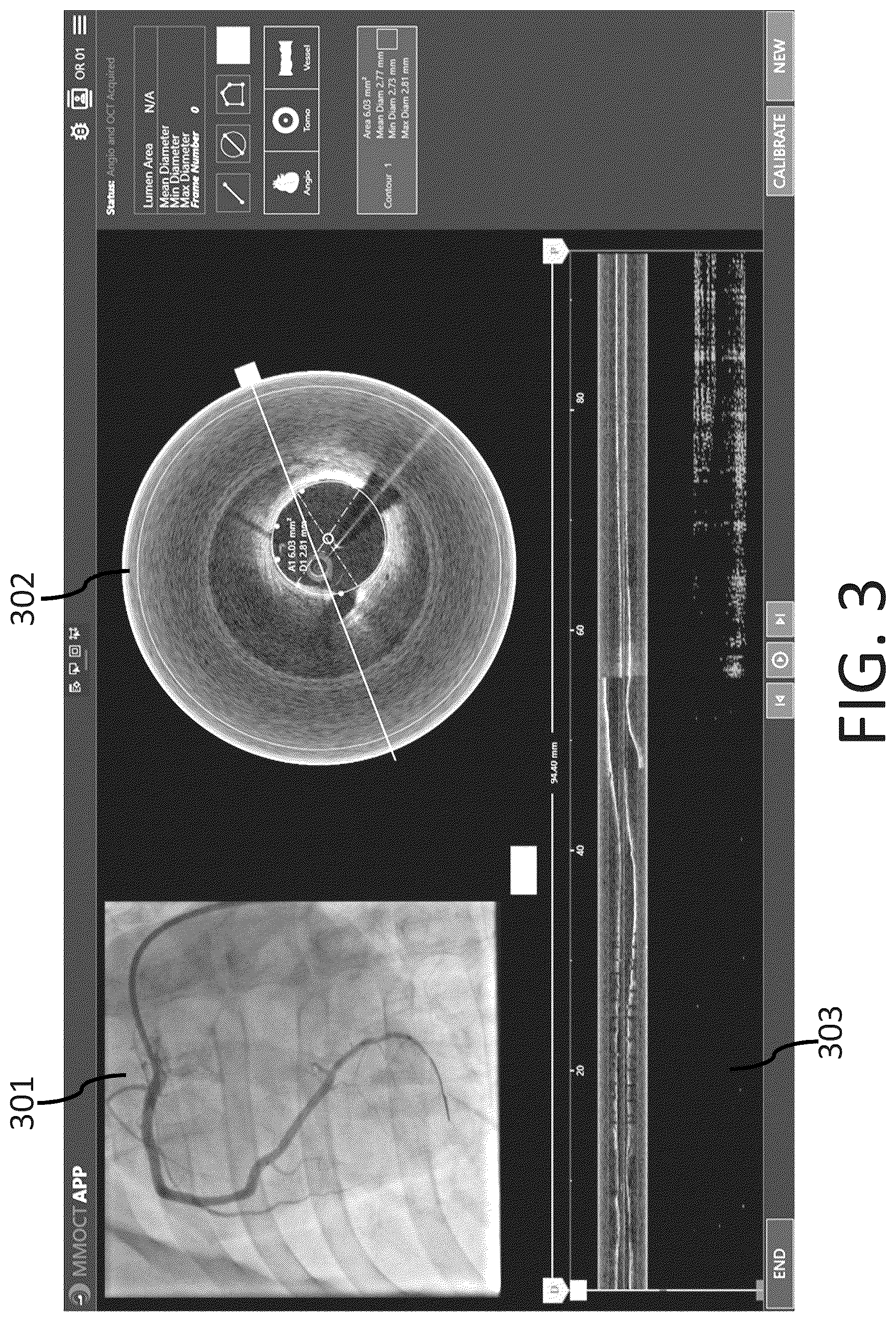 Patent US12551108 Figure 4 – Angiography image/video synchronization with pullback and angio delay measurement