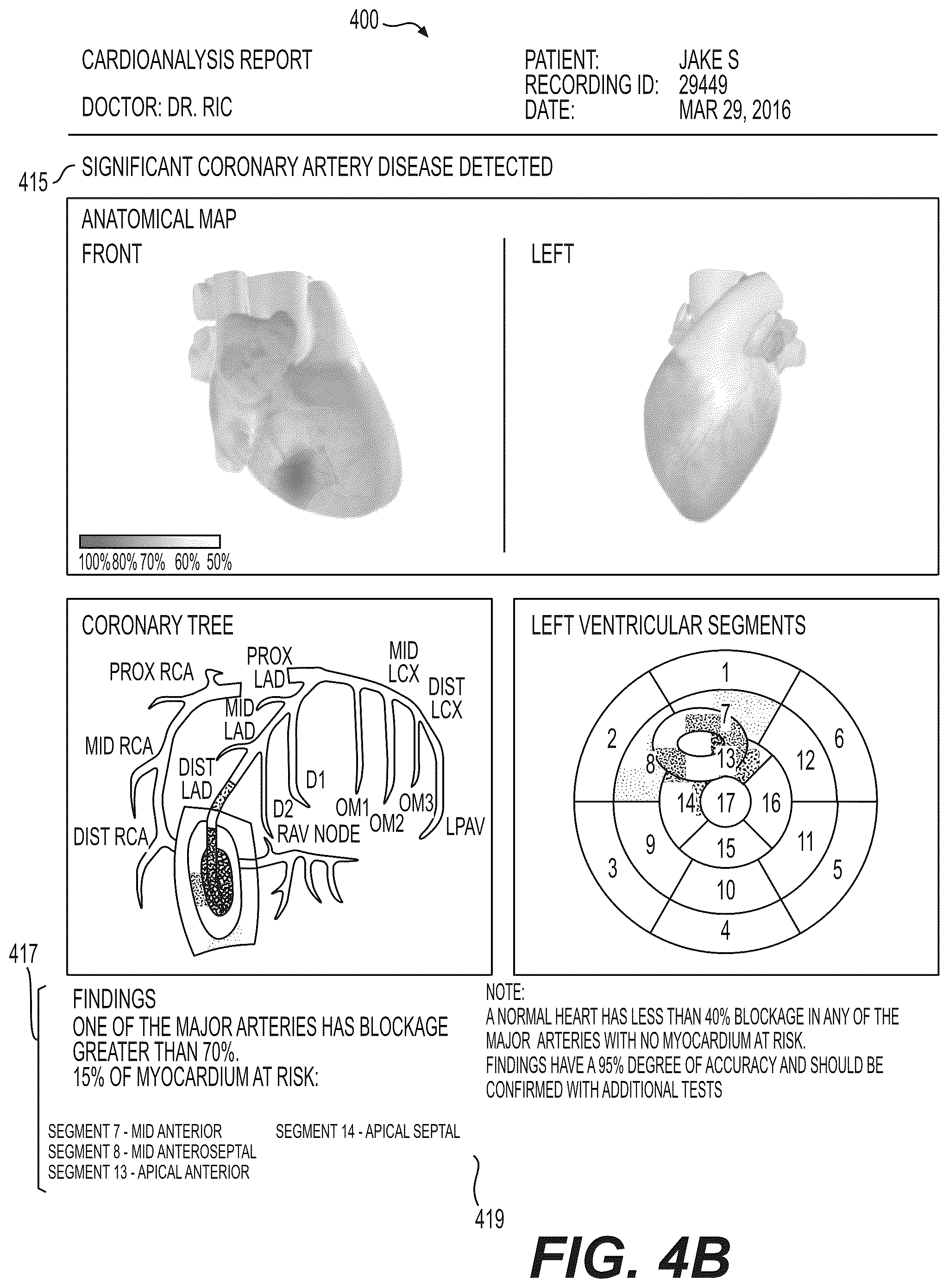 Patent US12551112 Figure 5 – Method and system for visualization of heart tissue at risk