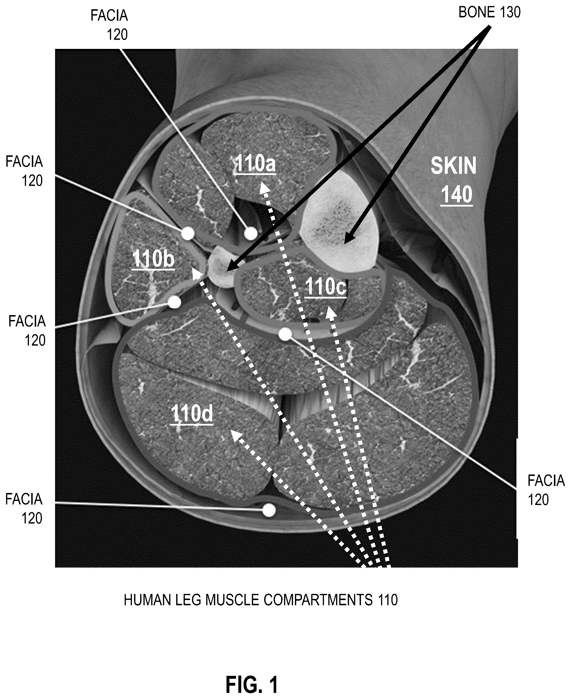 Patent US12551125 Figure 1 – Handheld non-invasive compartment syndrome detector
