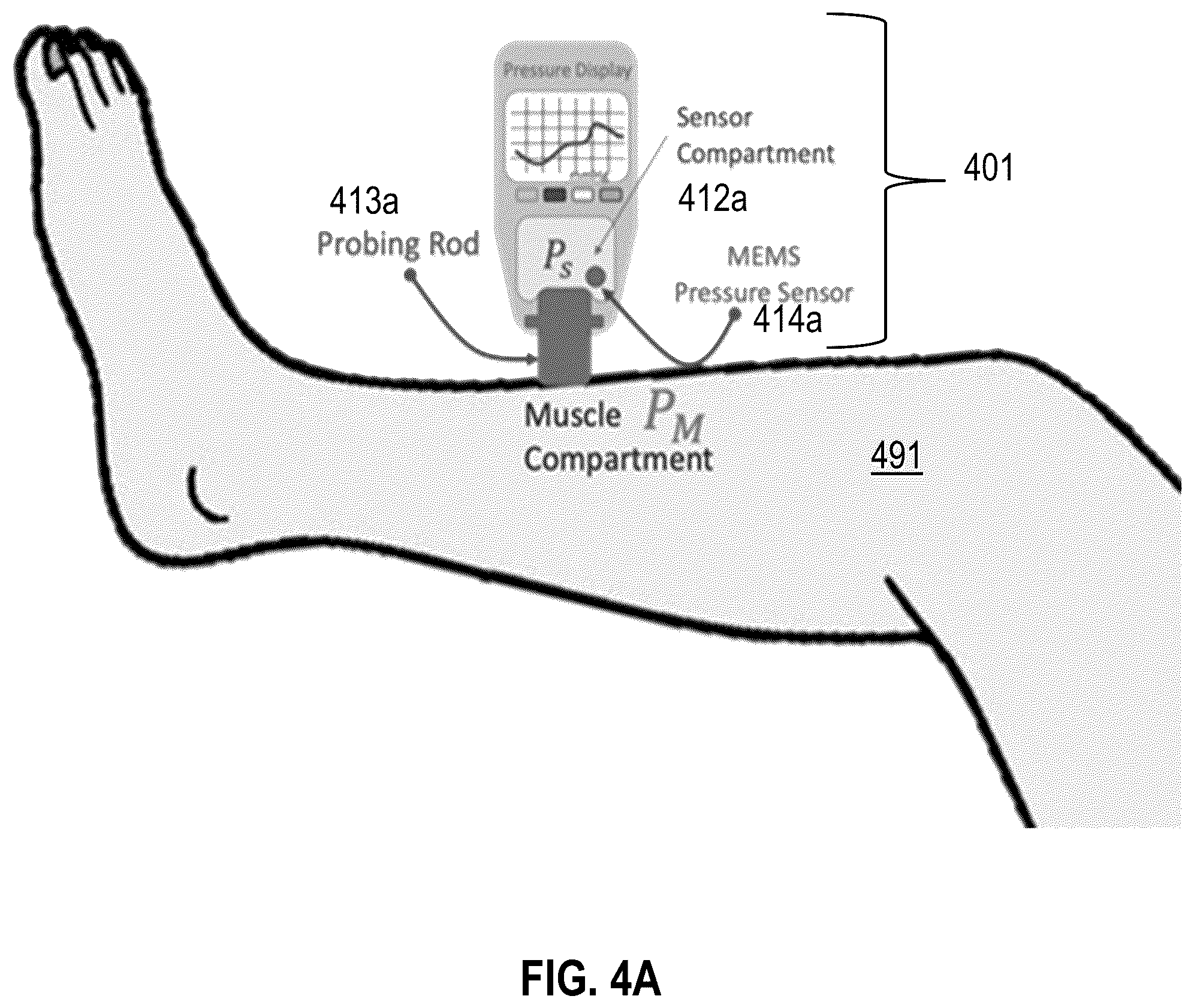 Patent US12551125 Figure 7 – Handheld non-invasive compartment syndrome detector