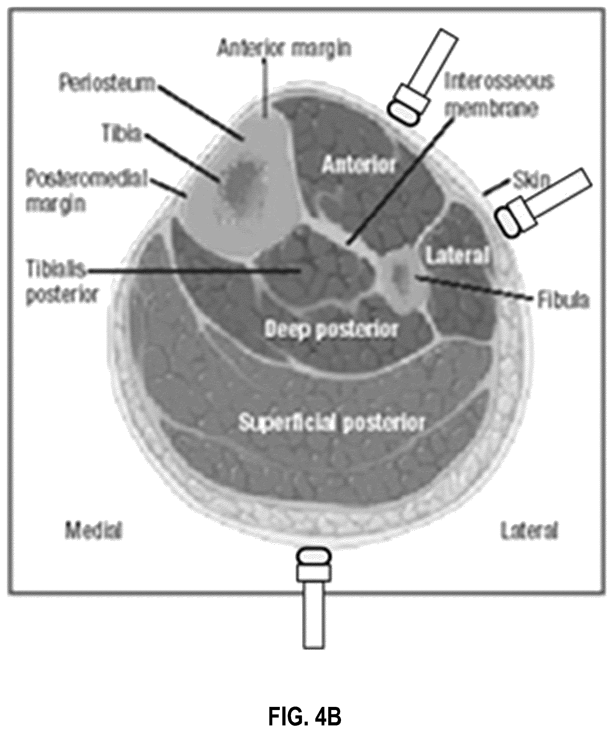 Patent US12551125 Figure 8 – Handheld non-invasive compartment syndrome detector