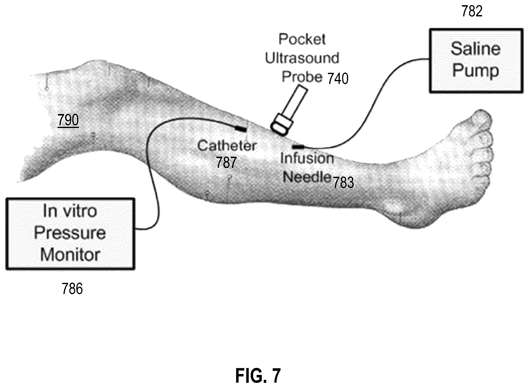 Patent US12551125 Figure 17 – Handheld non-invasive compartment syndrome detector