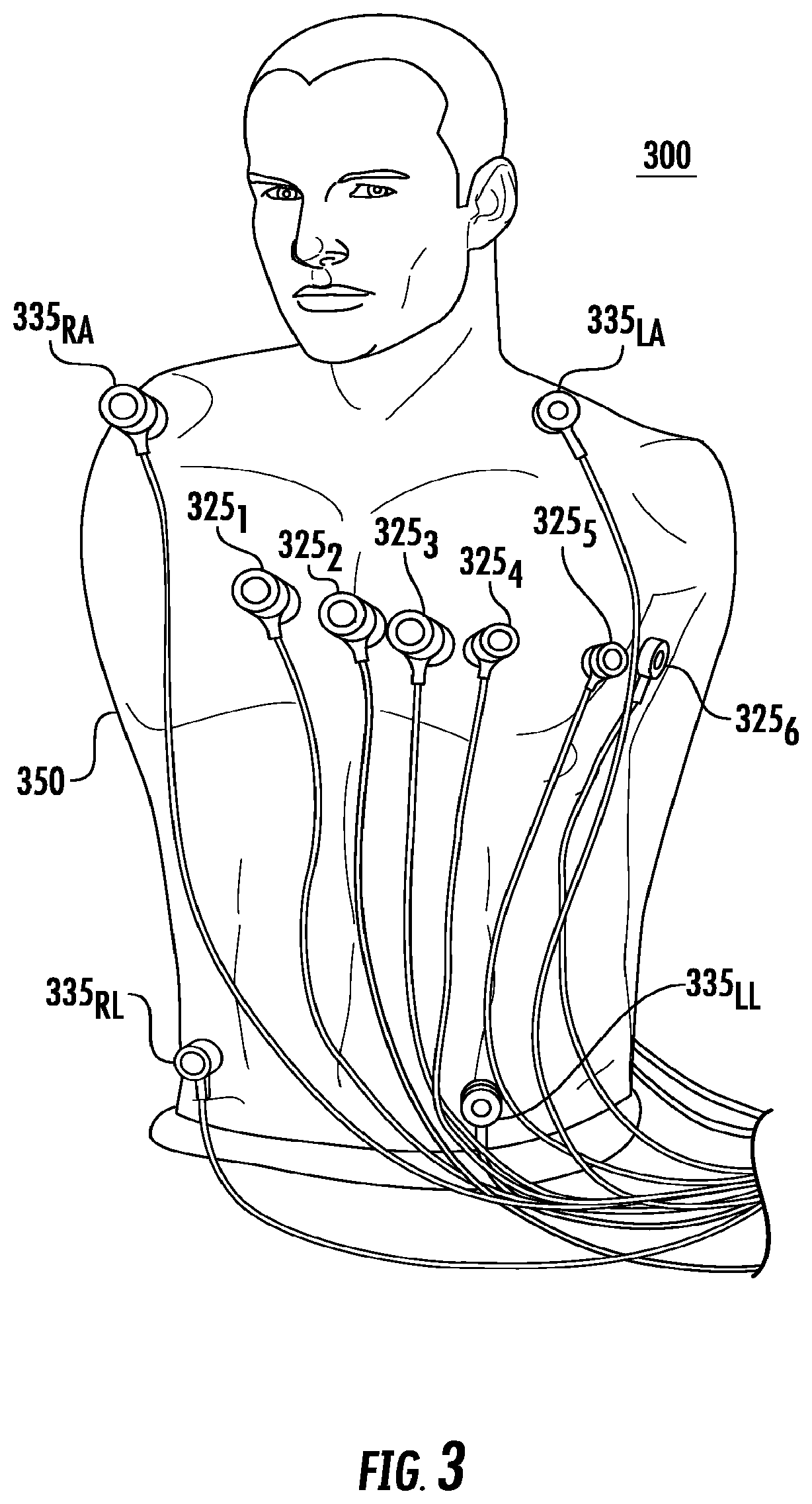 Patent US12551127 Figure 3 – Impedance measurements using burst pulses to prevent noise on ECG