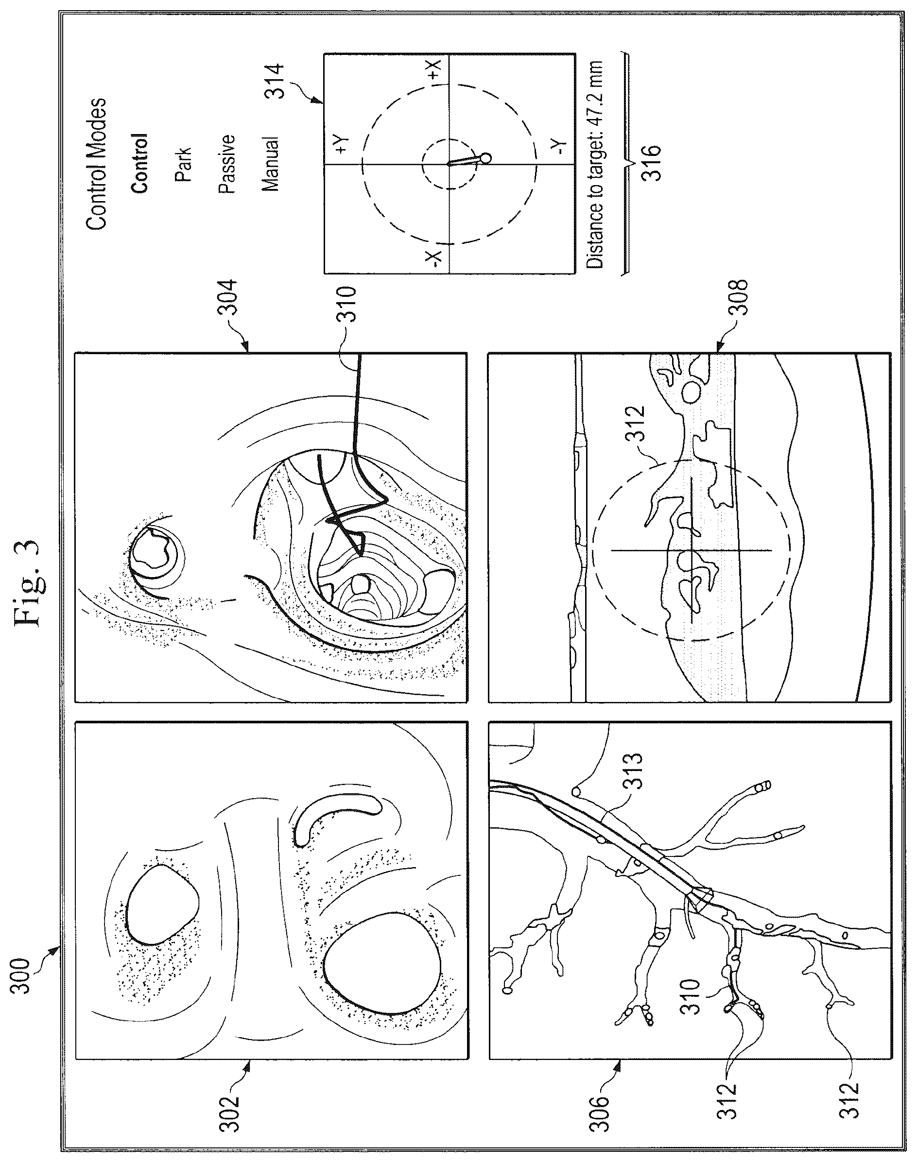 Patent US12551133 Figure 3 – Graphical user interface for catheter positioning and insertion