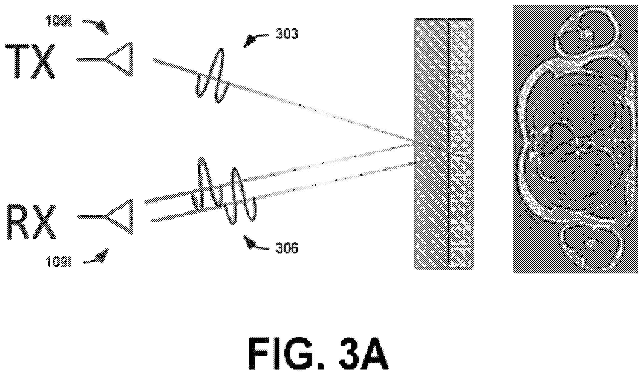 Patent US12551135 Figure 6 – Mobile ultrawideband radar monitoring thoracic fluid levels and cardio-respiratory function