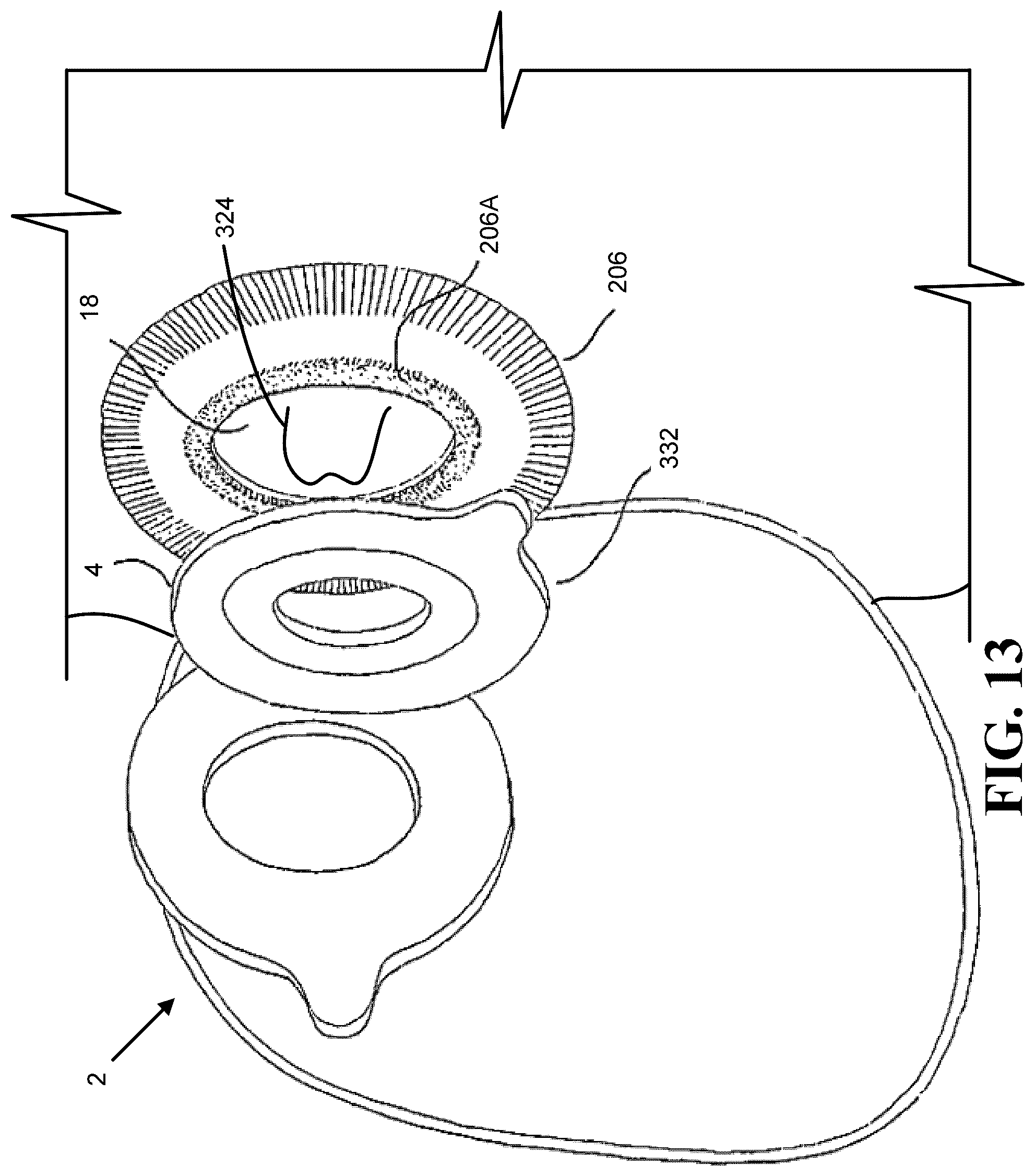 Patent US12551136 Figure 12 – Calibration methods for ostomy appliance tools
