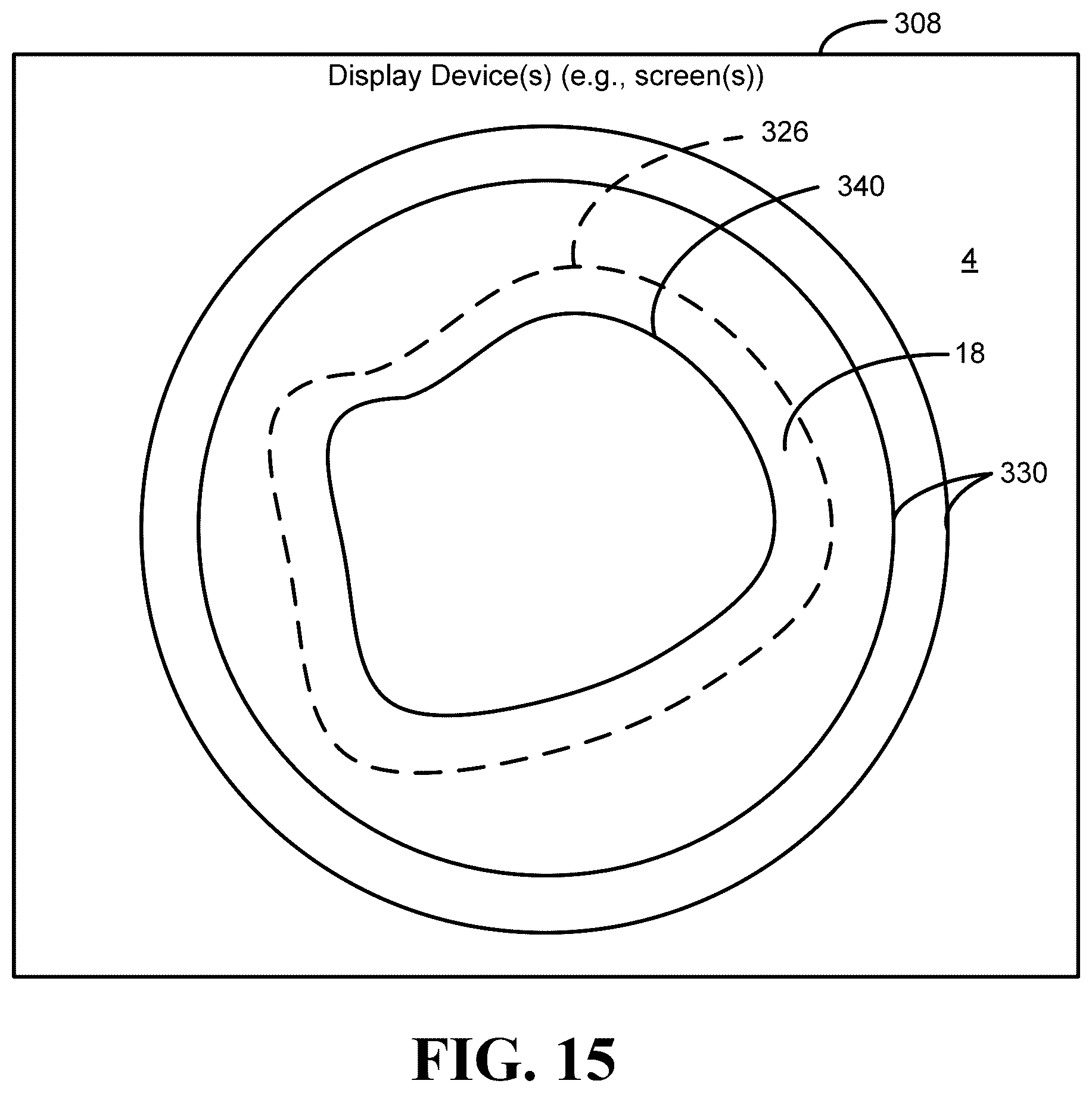 Patent US12551136 Figure 14 – Calibration methods for ostomy appliance tools
