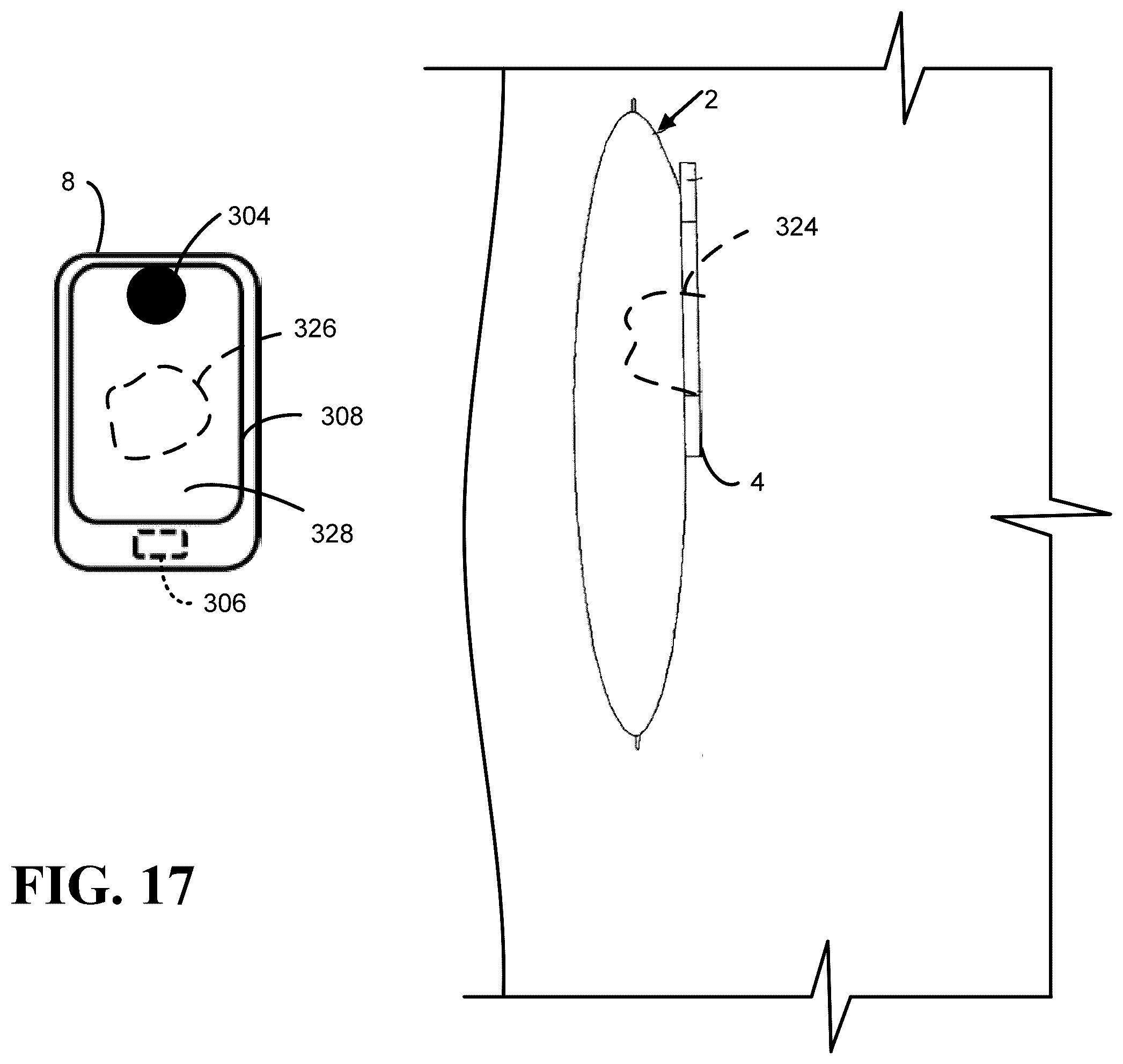 Patent US12551136 Figure 16 – Calibration methods for ostomy appliance tools