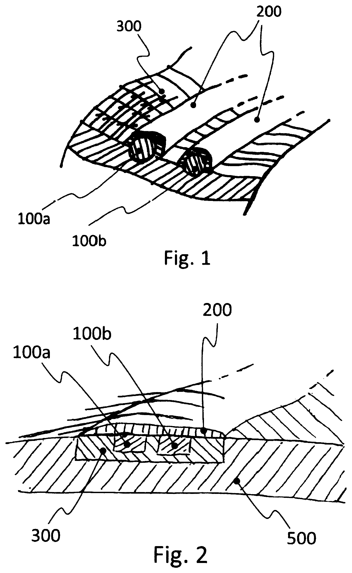 Patent US12551146 Figure 1 – Biosensor and related wound dressing system