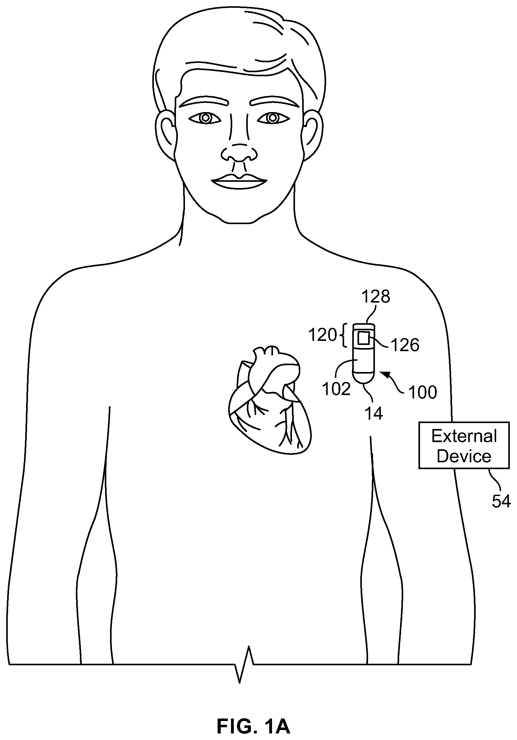 Patent US12551153 Figure 1 – Implantable medical device with multi-sided header electrode
