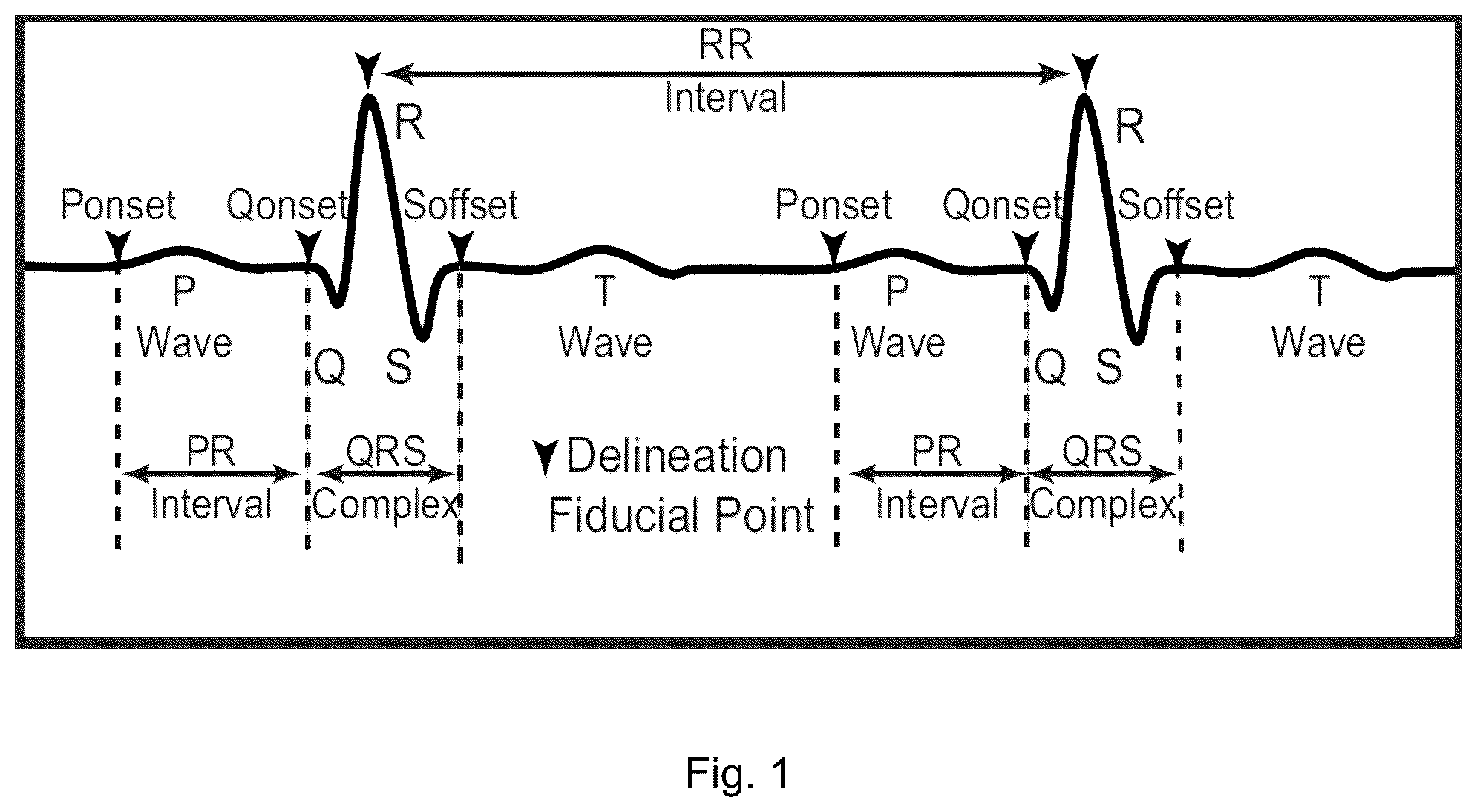 Patent US12551155 Figure 1 – Electrocardiogram sensing and processing