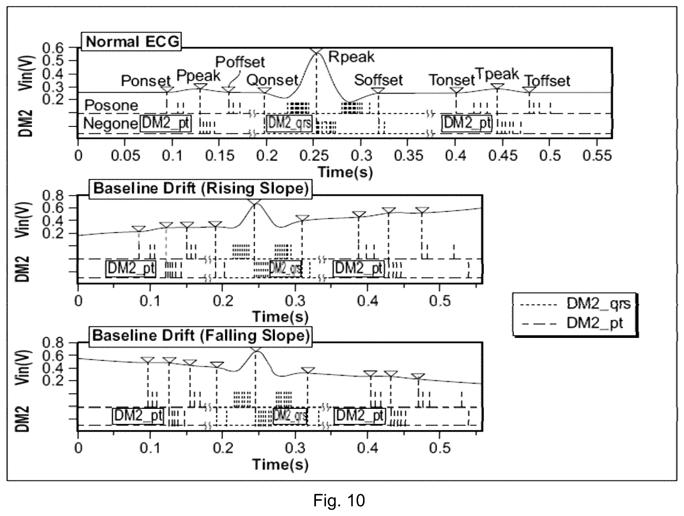 Patent US12551155 Figure 12 – Electrocardiogram sensing and processing