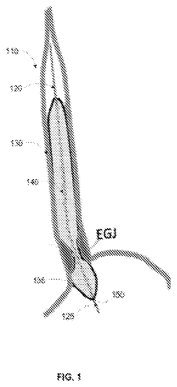 Patent US12551159 Figure 1 – Analysis and display of functional lumen imaging probe (FLIP) data