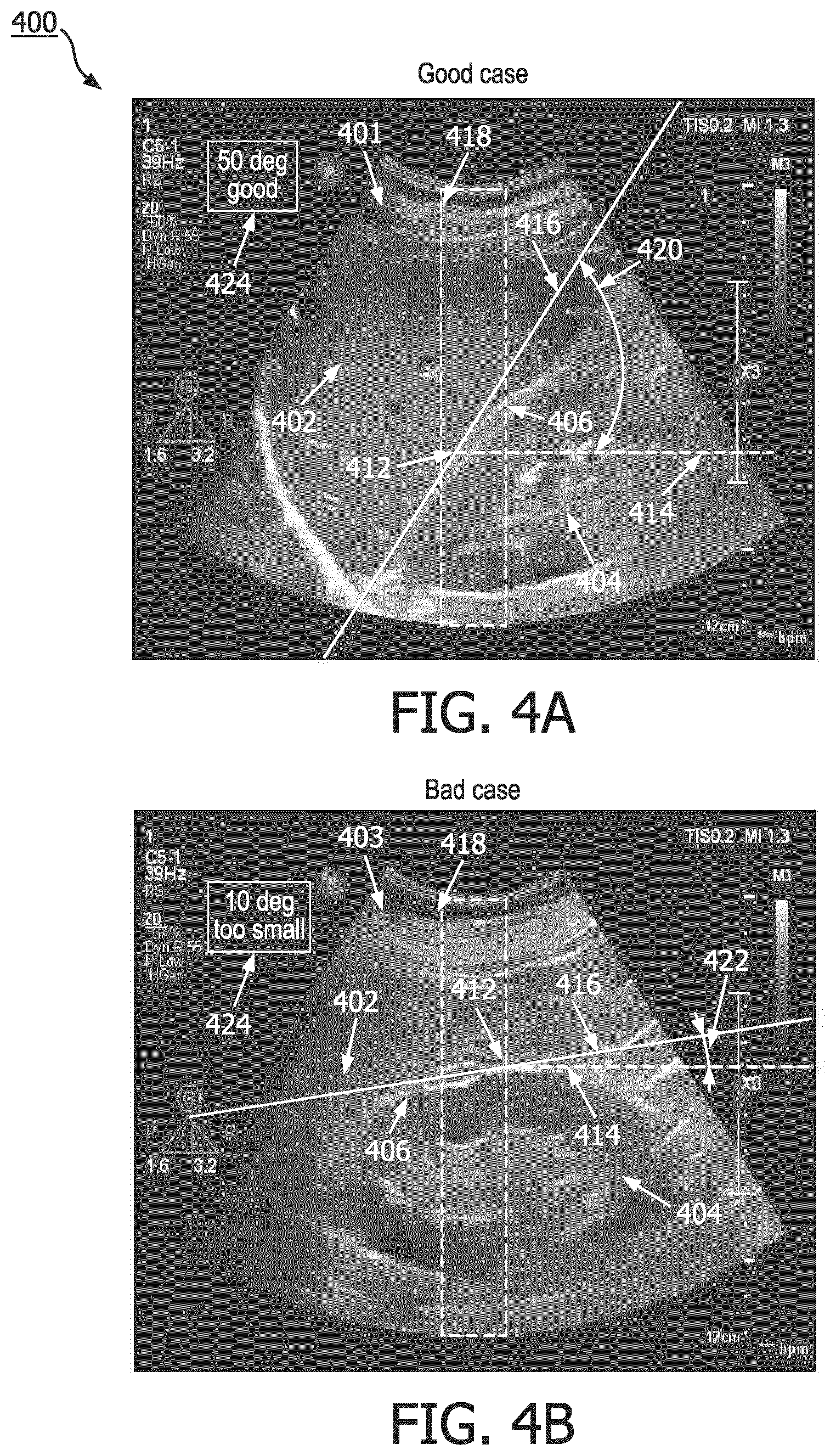 Patent US12551187 Figure 4 – Systems and methods of providing user guidance for acquiring hepato-renal index measurements