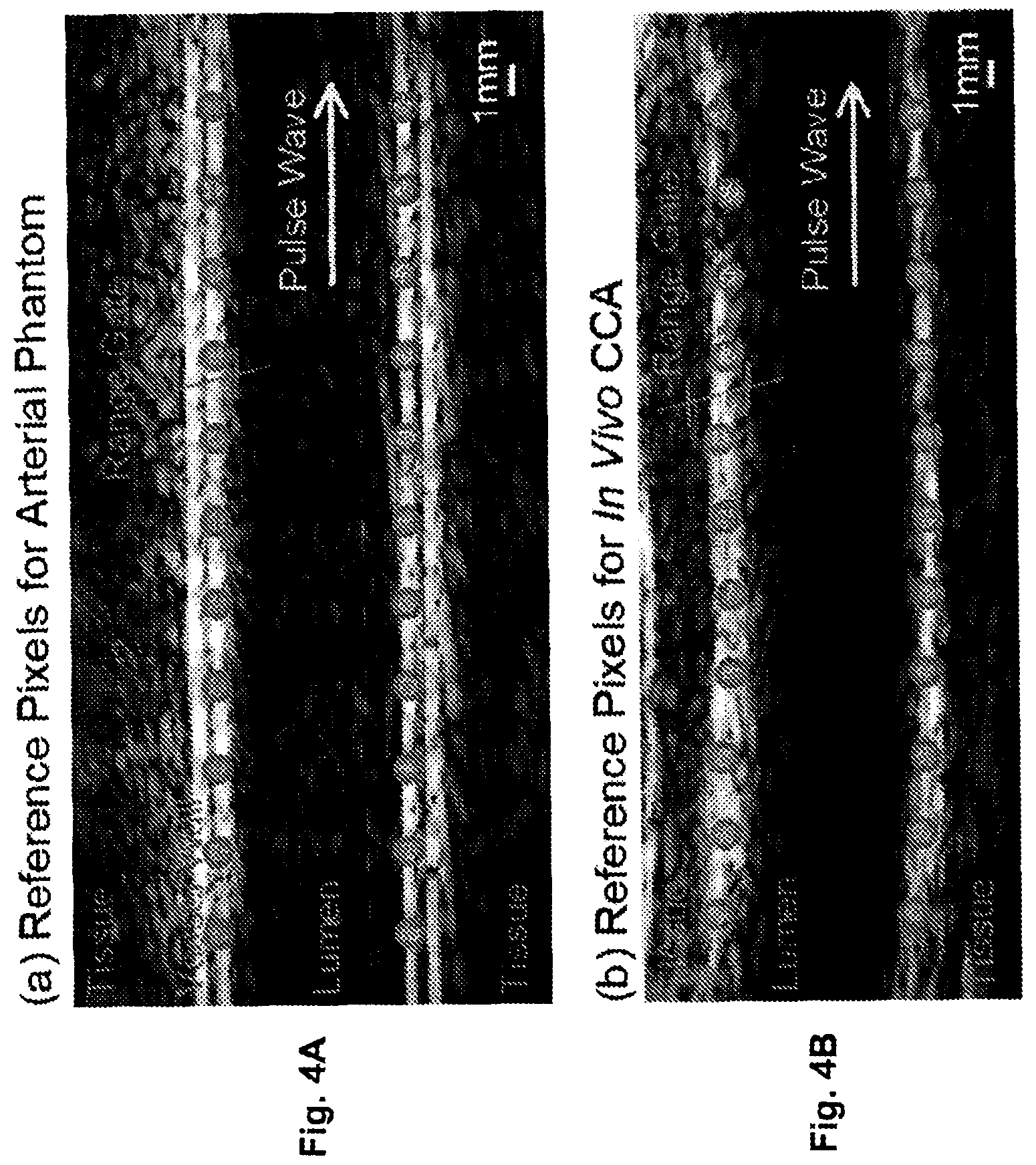 Patent US12551196 Figure 4 – Measuring pulse wave velocity using ultrasound