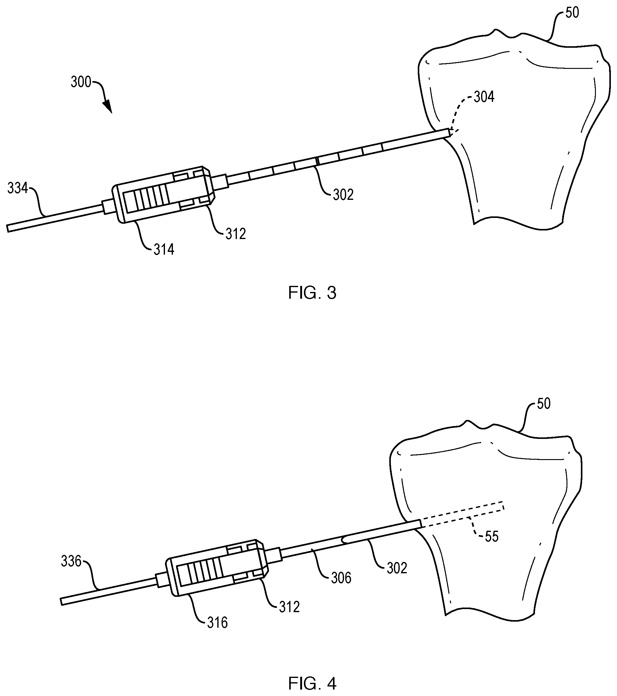 Patent US12551201 Figure 3 – Bone access, bone capture, and aspiration devices