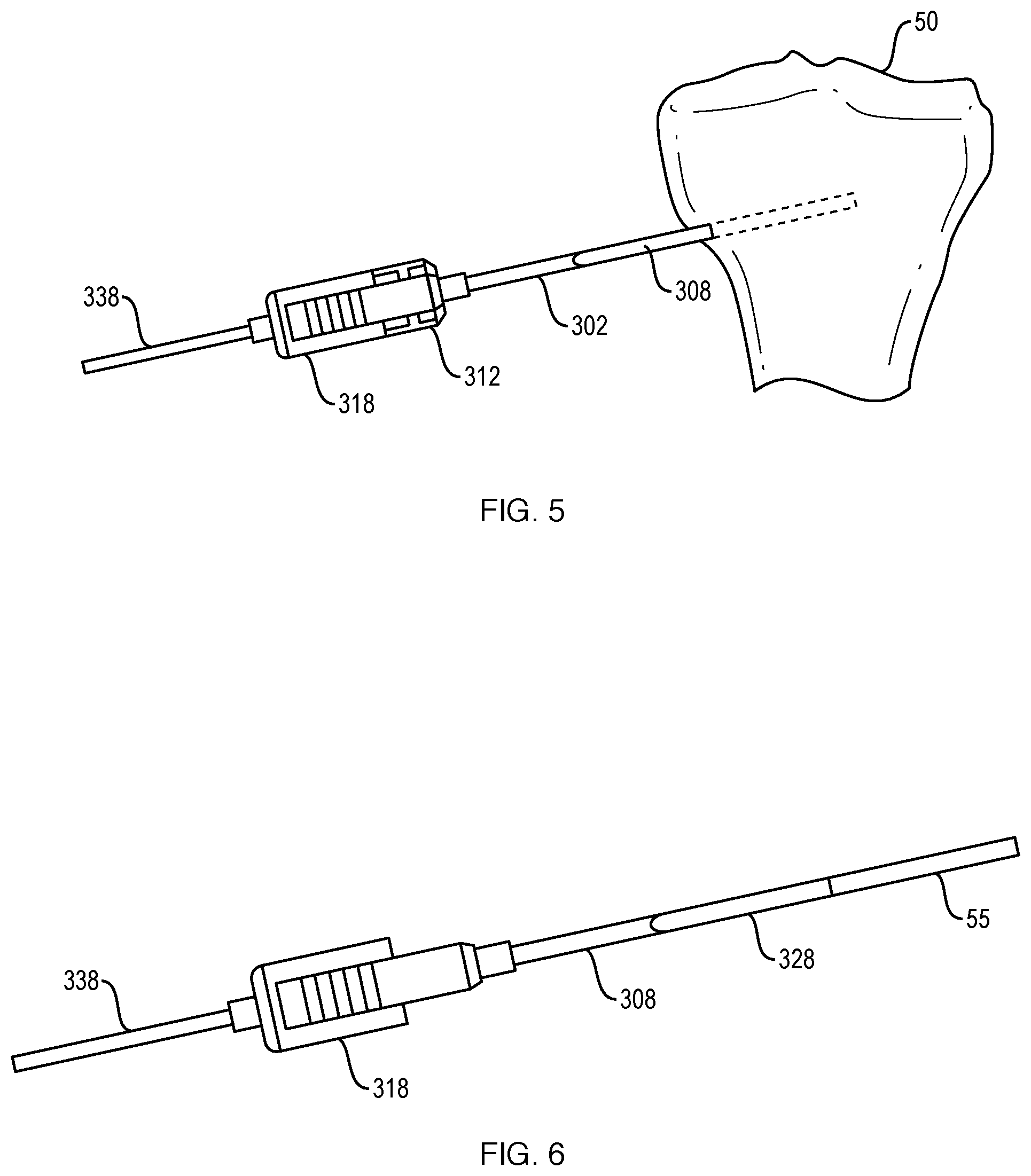 Patent US12551201 Figure 4 – Bone access, bone capture, and aspiration devices