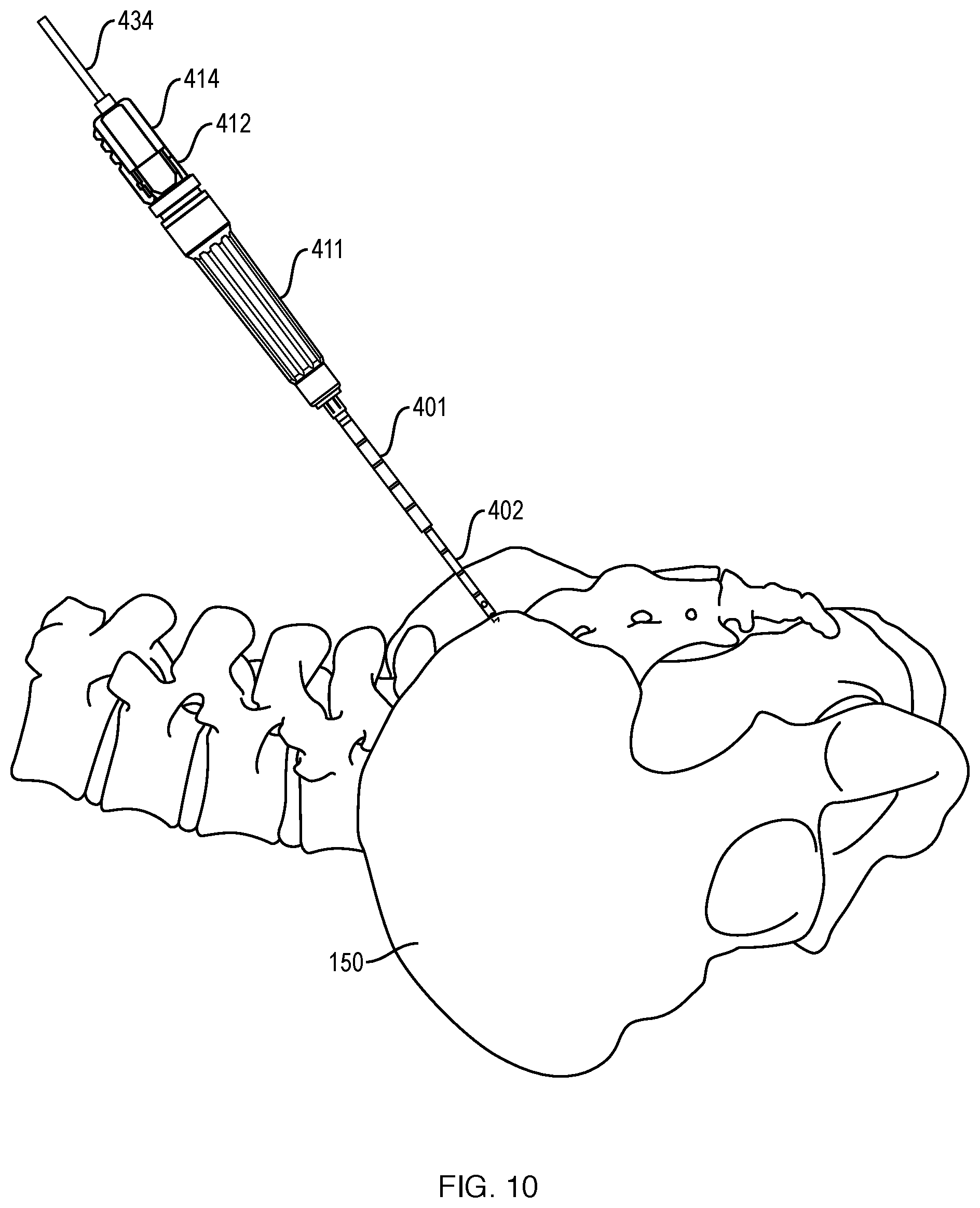 Patent US12551201 Figure 12 – Bone access, bone capture, and aspiration devices