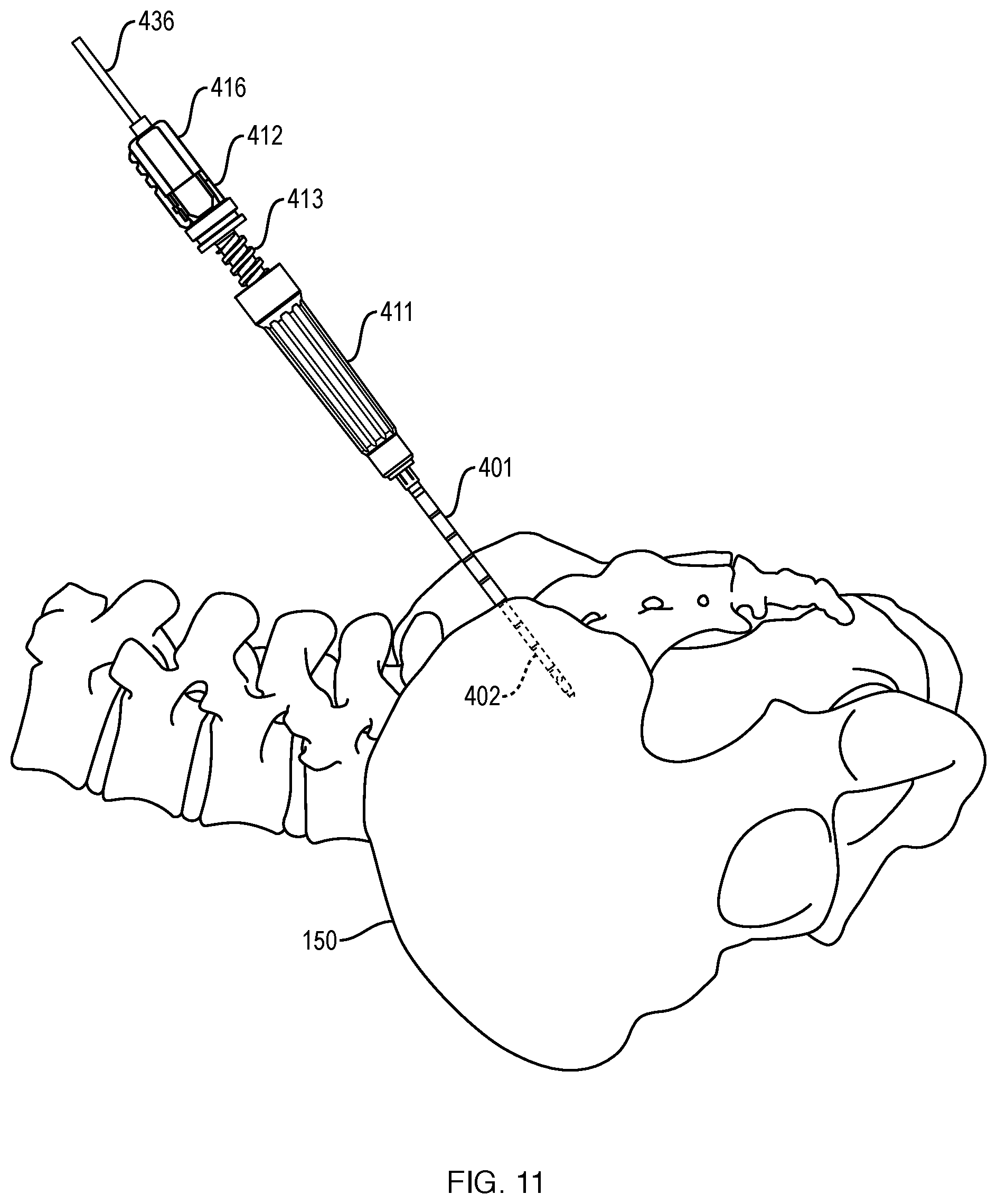 Patent US12551201 Figure 13 – Bone access, bone capture, and aspiration devices