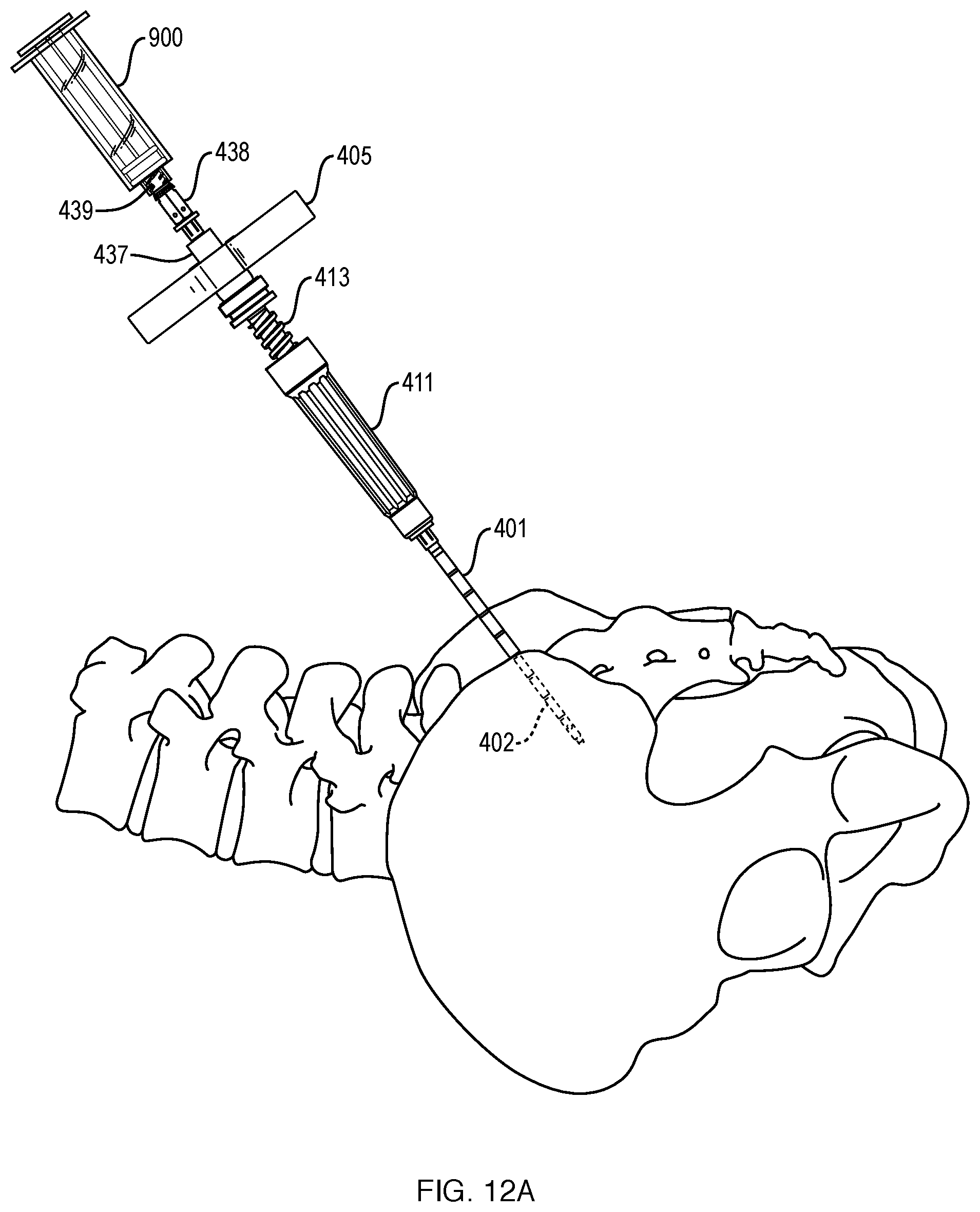 Patent US12551201 Figure 14 – Bone access, bone capture, and aspiration devices