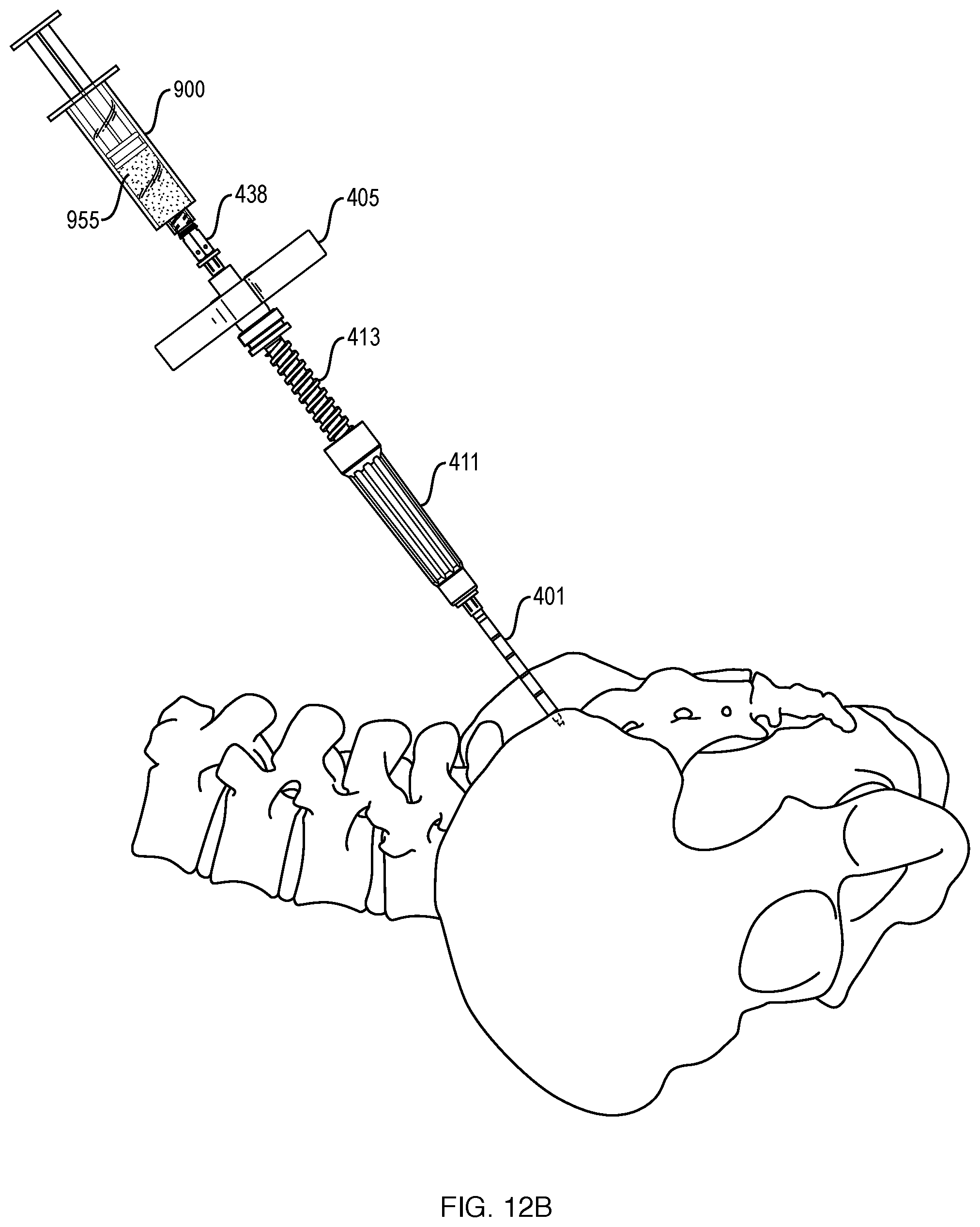 Patent US12551201 Figure 15 – Bone access, bone capture, and aspiration devices