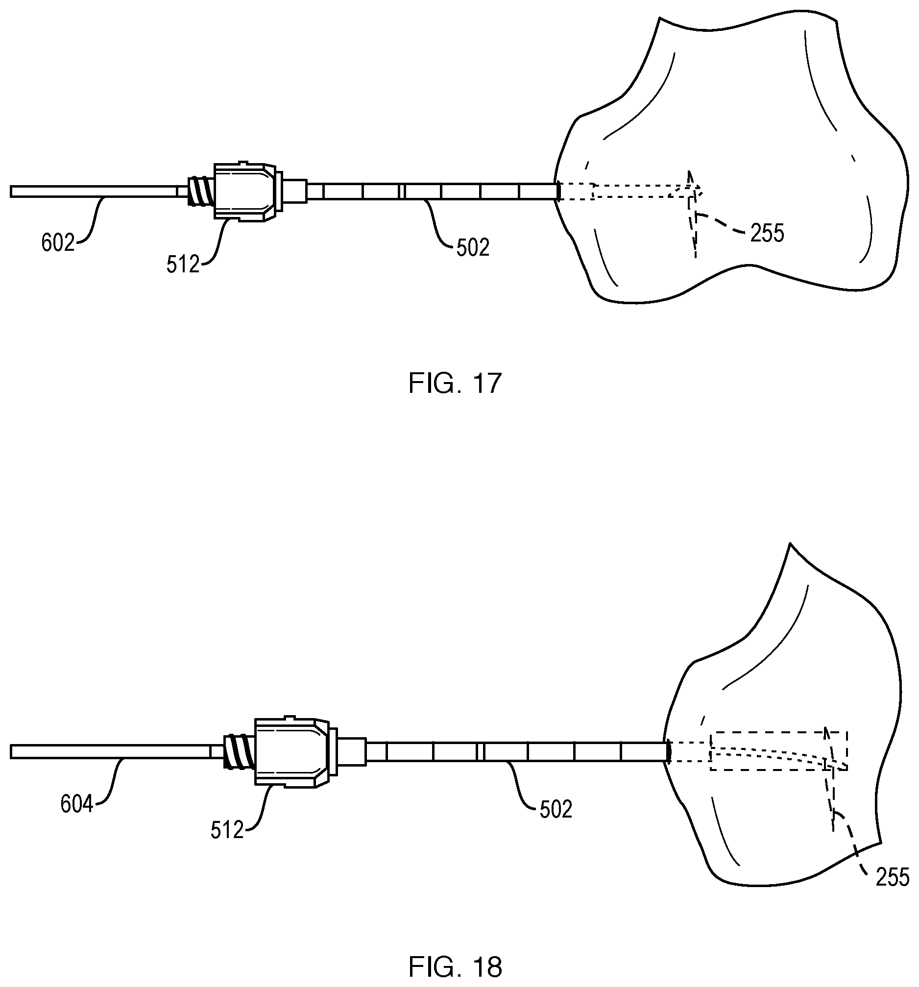 Patent US12551201 Figure 18 – Bone access, bone capture, and aspiration devices