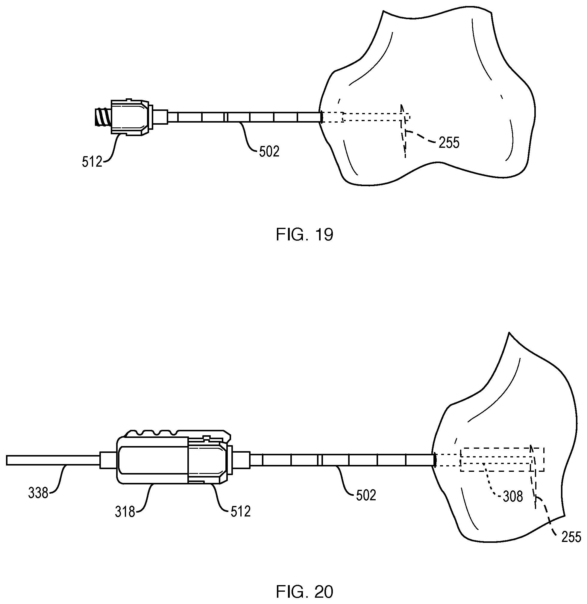 Patent US12551201 Figure 19 – Bone access, bone capture, and aspiration devices
