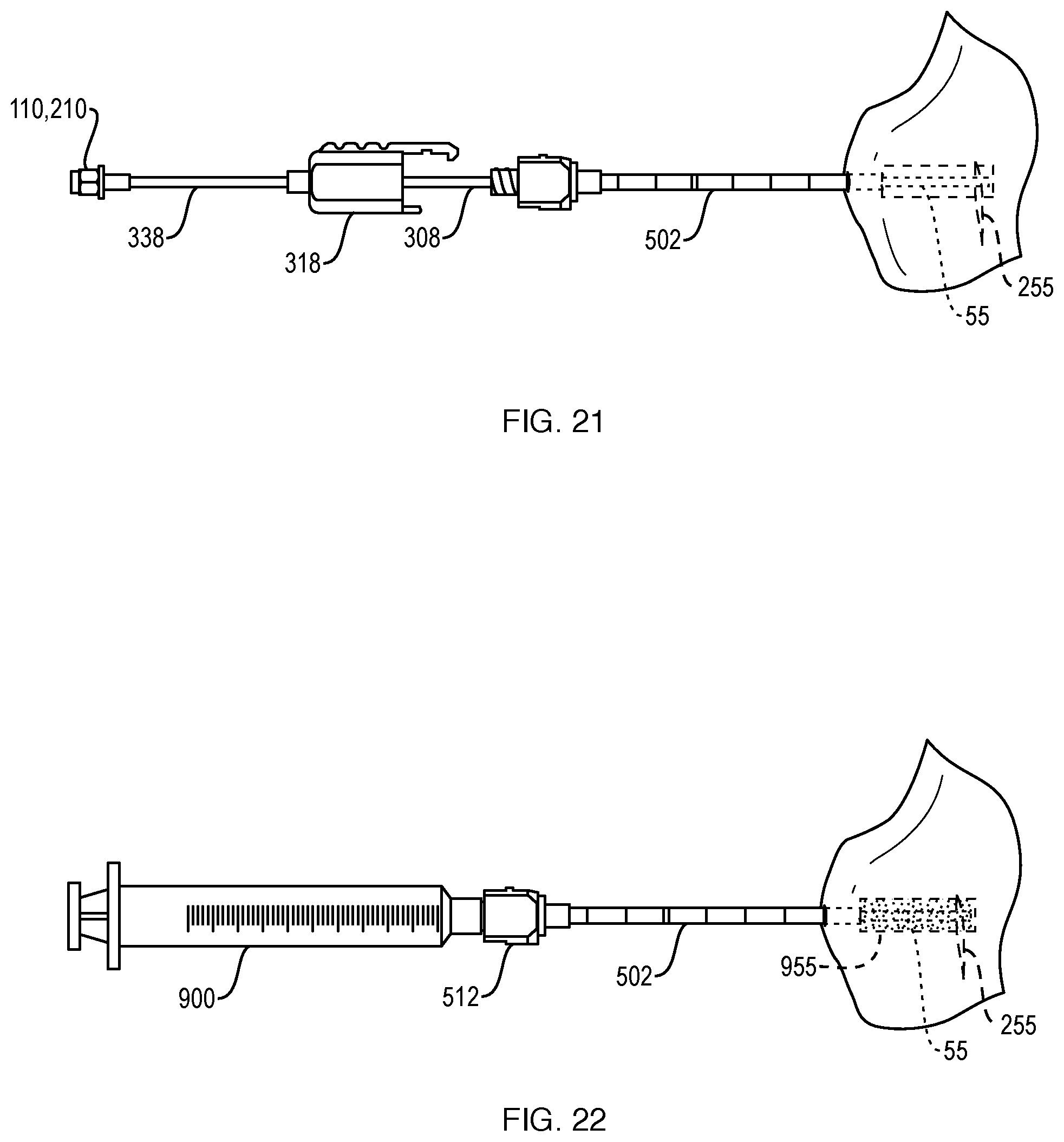 Patent US12551201 Figure 20 – Bone access, bone capture, and aspiration devices