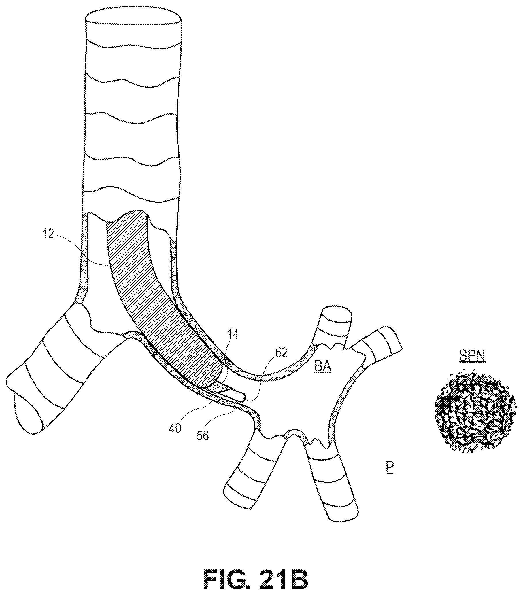 Patent US12551204 Figure 17 – Lung access device