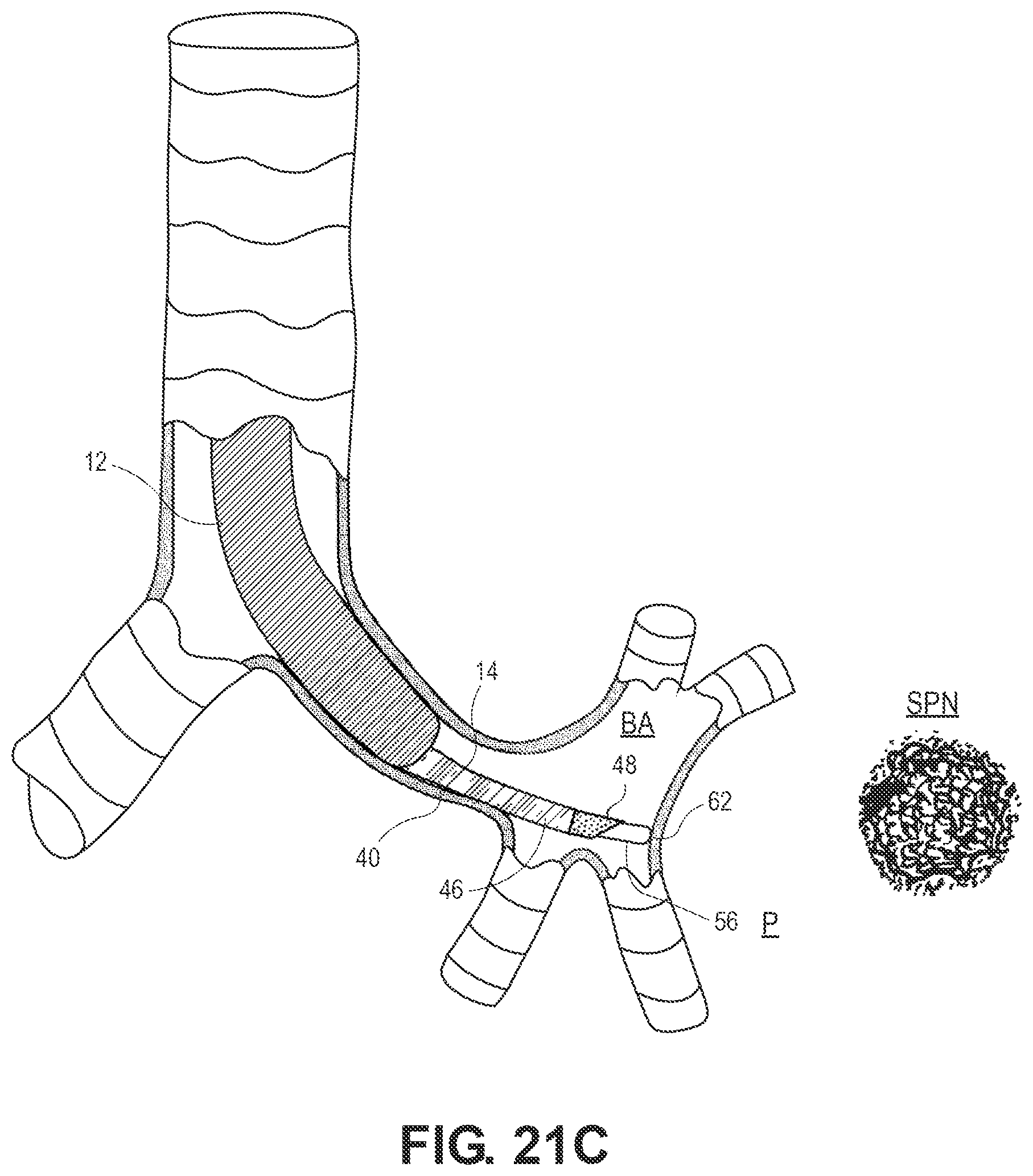 Patent US12551204 Figure 18 – Lung access device