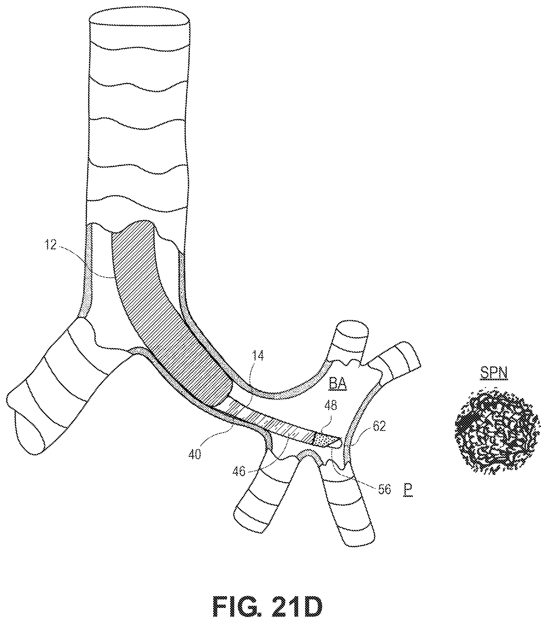 Patent US12551204 Figure 19 – Lung access device