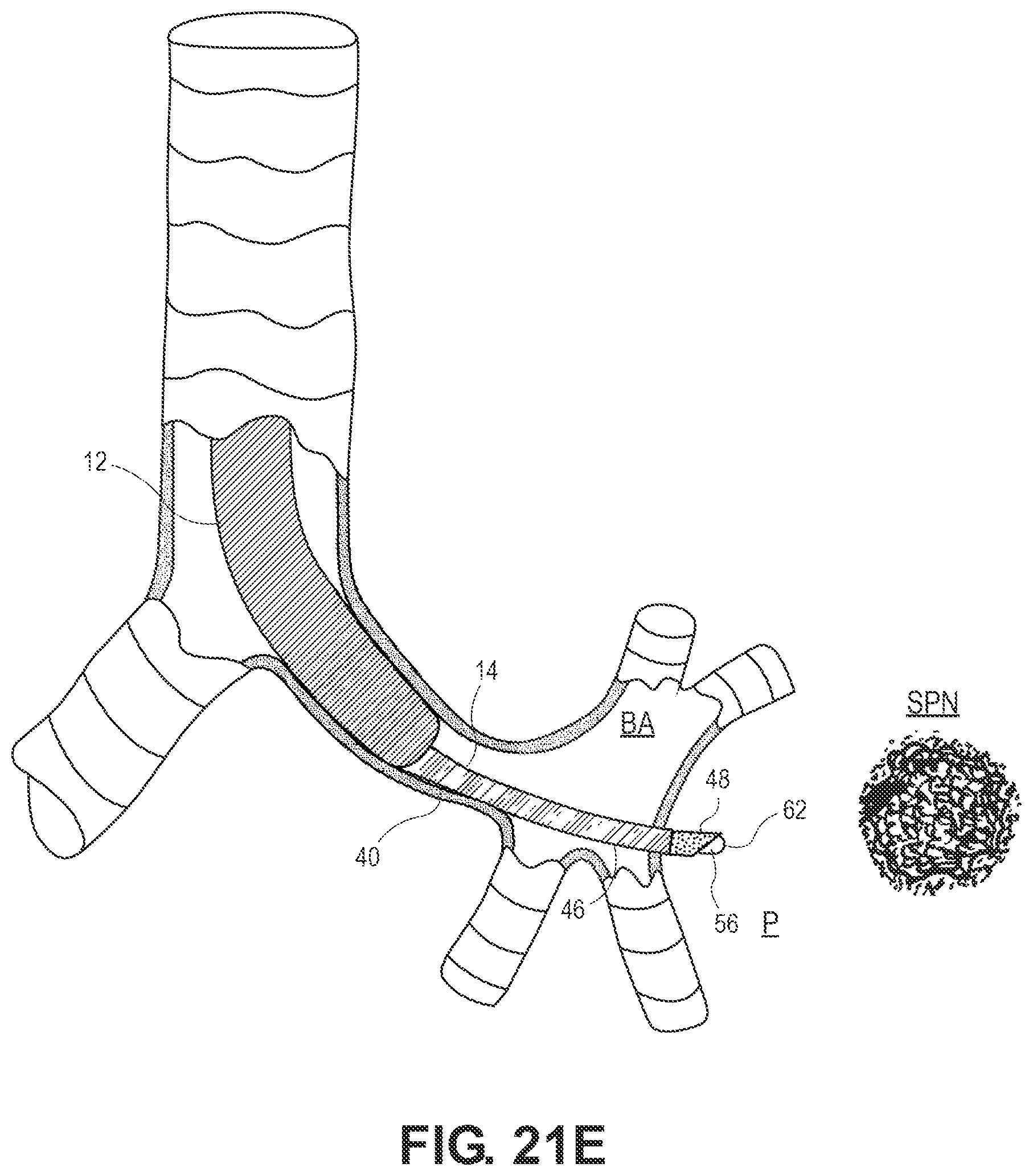 Patent US12551204 Figure 20 – Lung access device