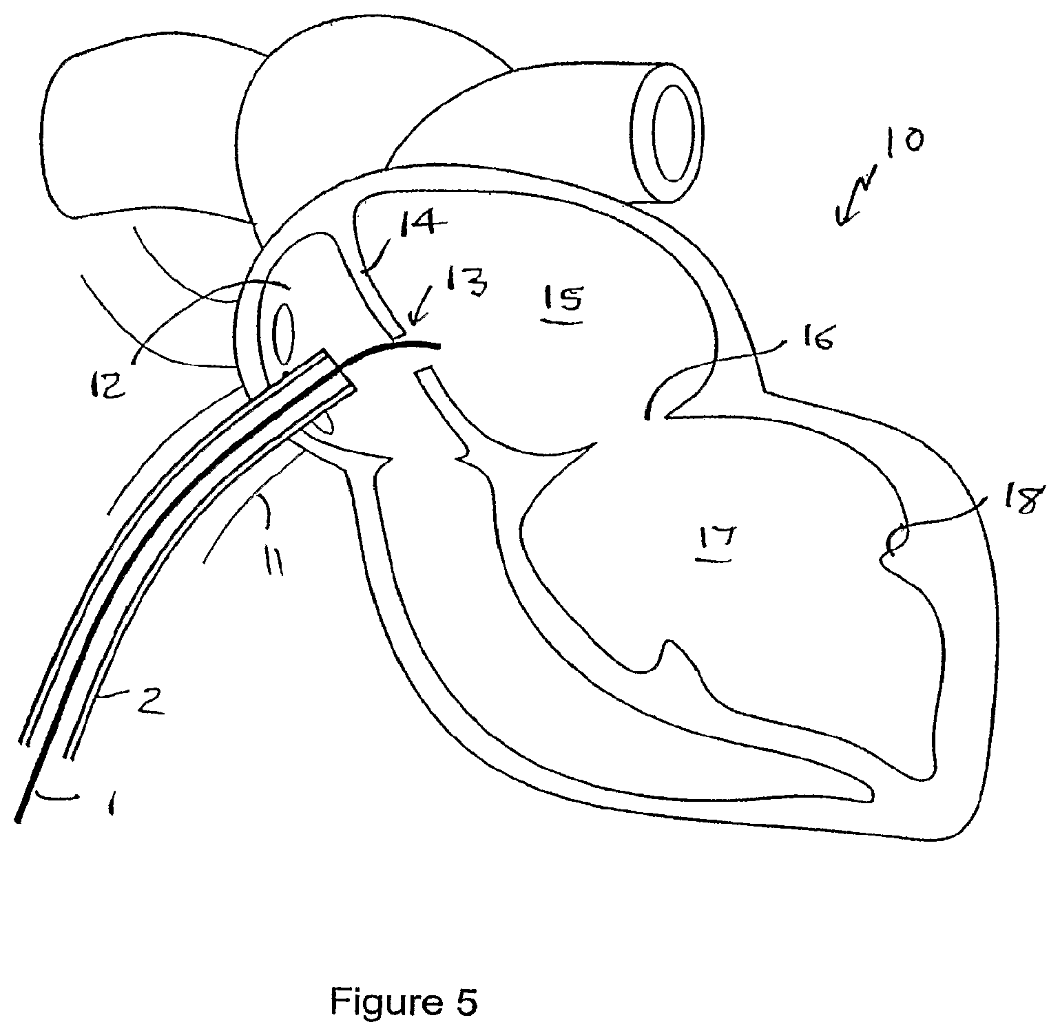Patent US12551207 Figure 3 – Heart valve prosthesis and method