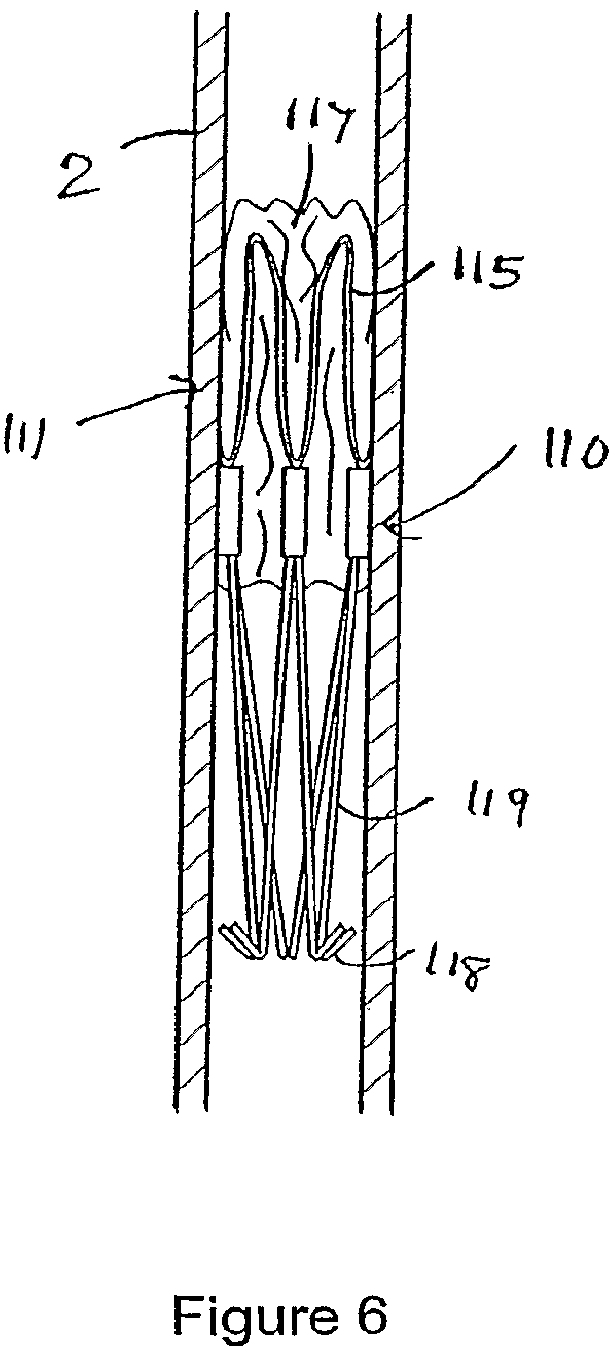 Patent US12551207 Figure 4 – Heart valve prosthesis and method