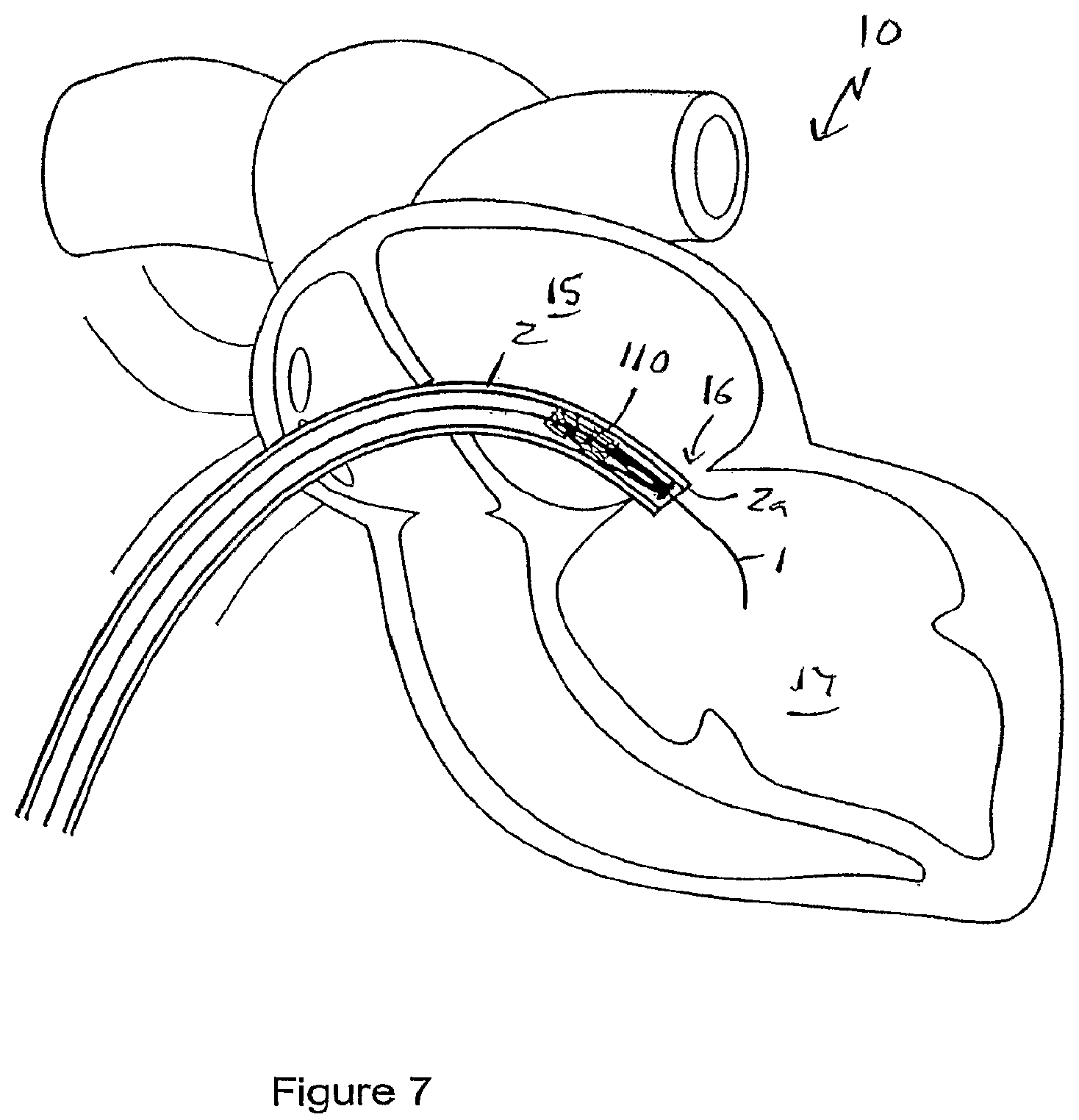 Patent US12551207 Figure 5 – Heart valve prosthesis and method