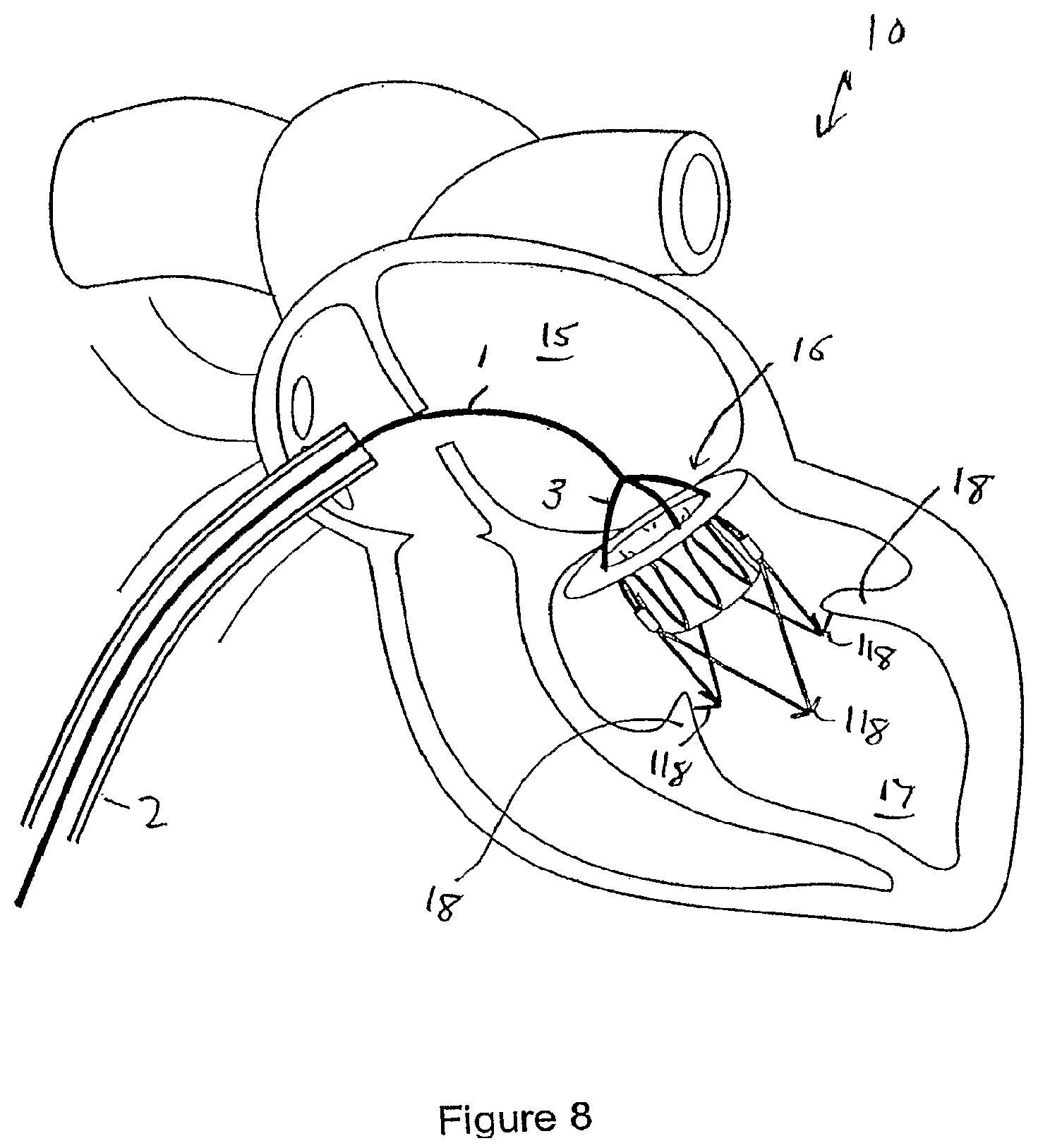 Patent US12551207 Figure 6 – Heart valve prosthesis and method
