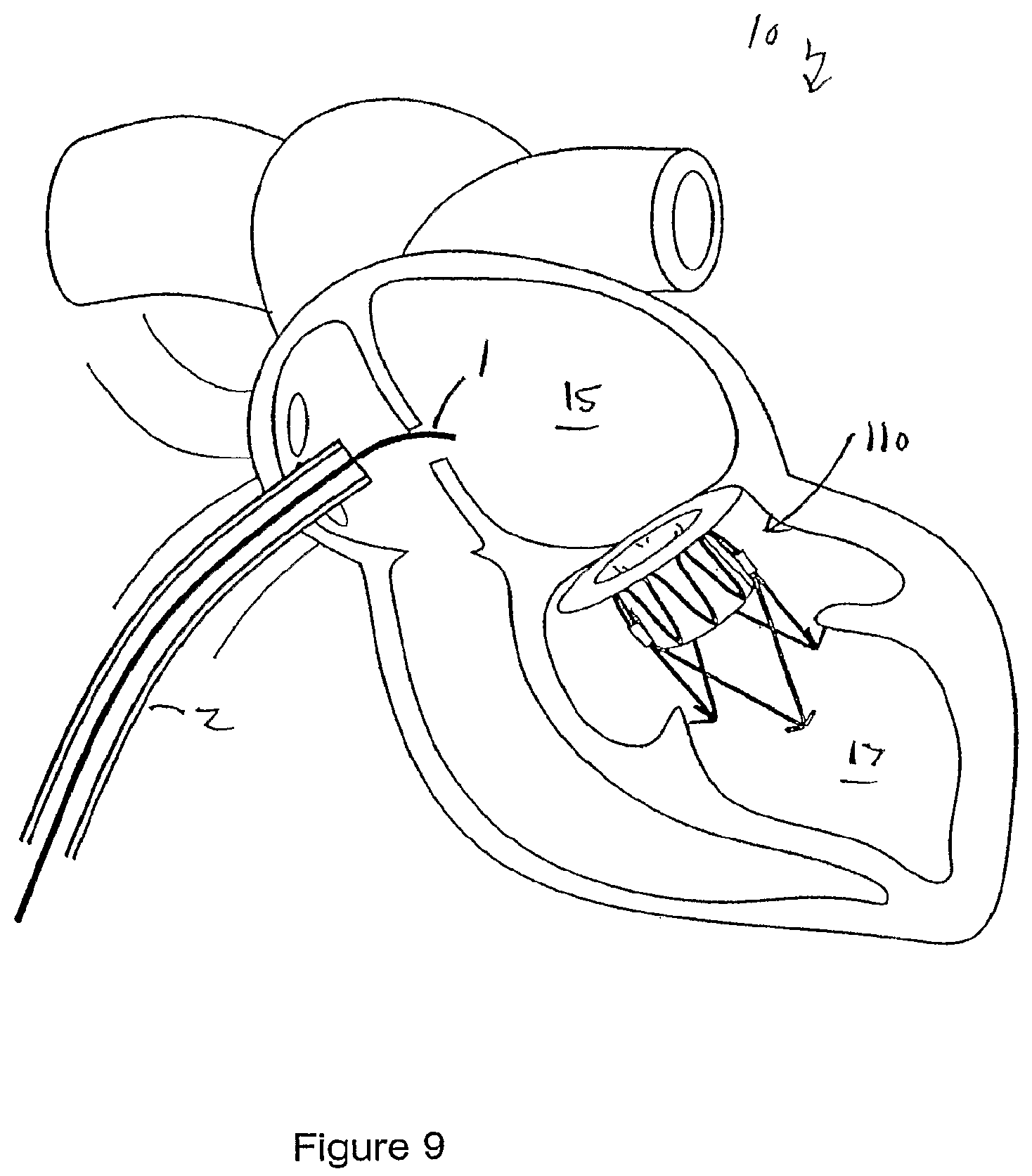 Patent US12551207 Figure 7 – Heart valve prosthesis and method