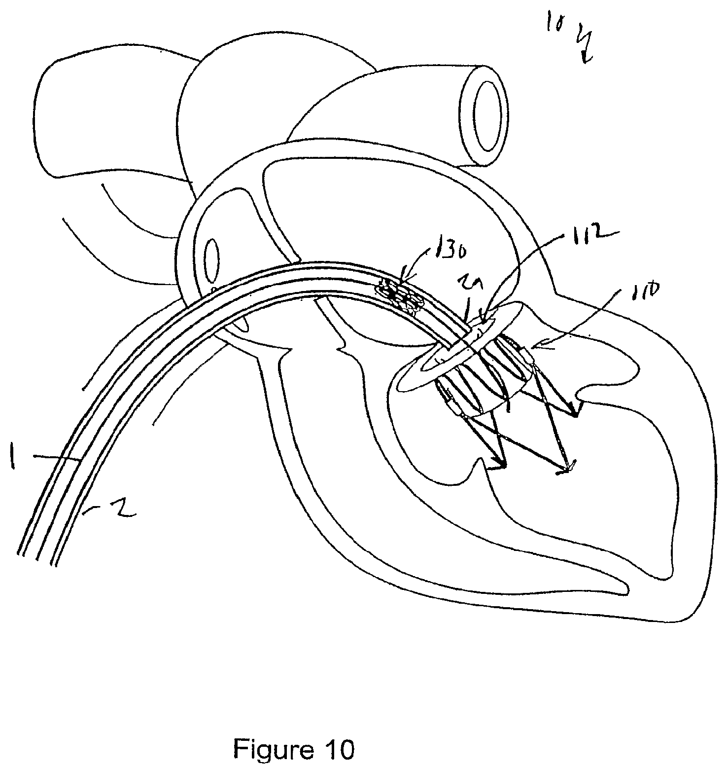 Patent US12551207 Figure 8 – Heart valve prosthesis and method