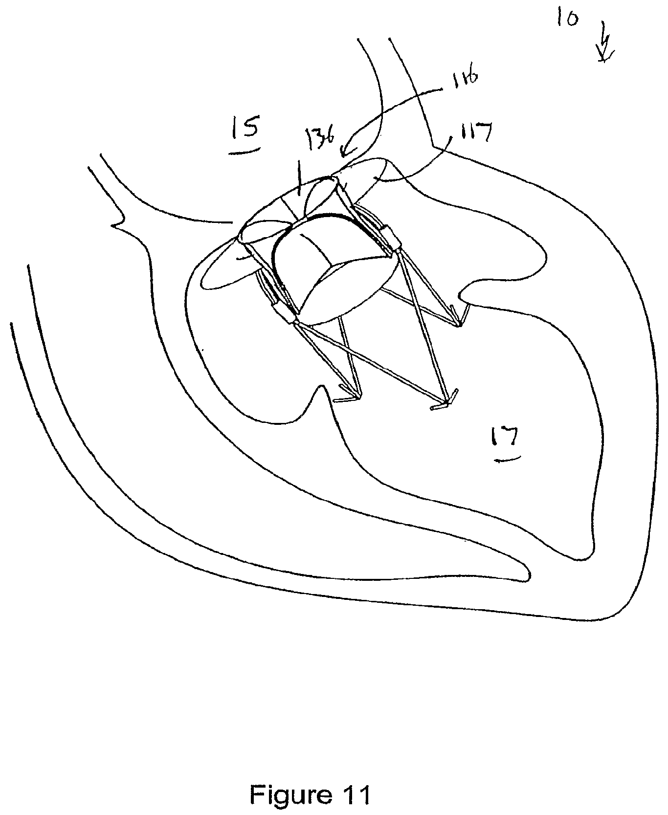 Patent US12551207 Figure 9 – Heart valve prosthesis and method