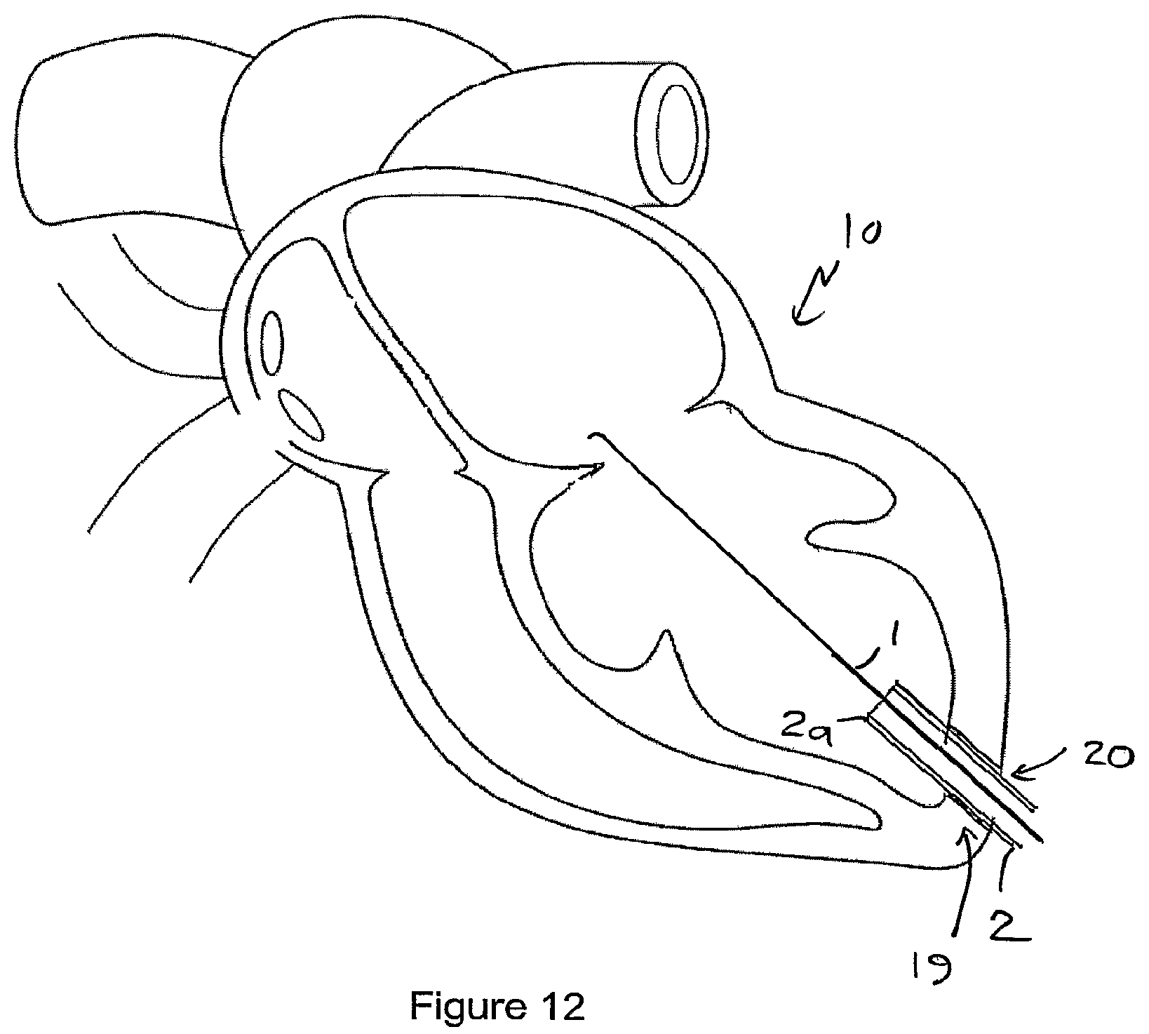 Patent US12551207 Figure 10 – Heart valve prosthesis and method