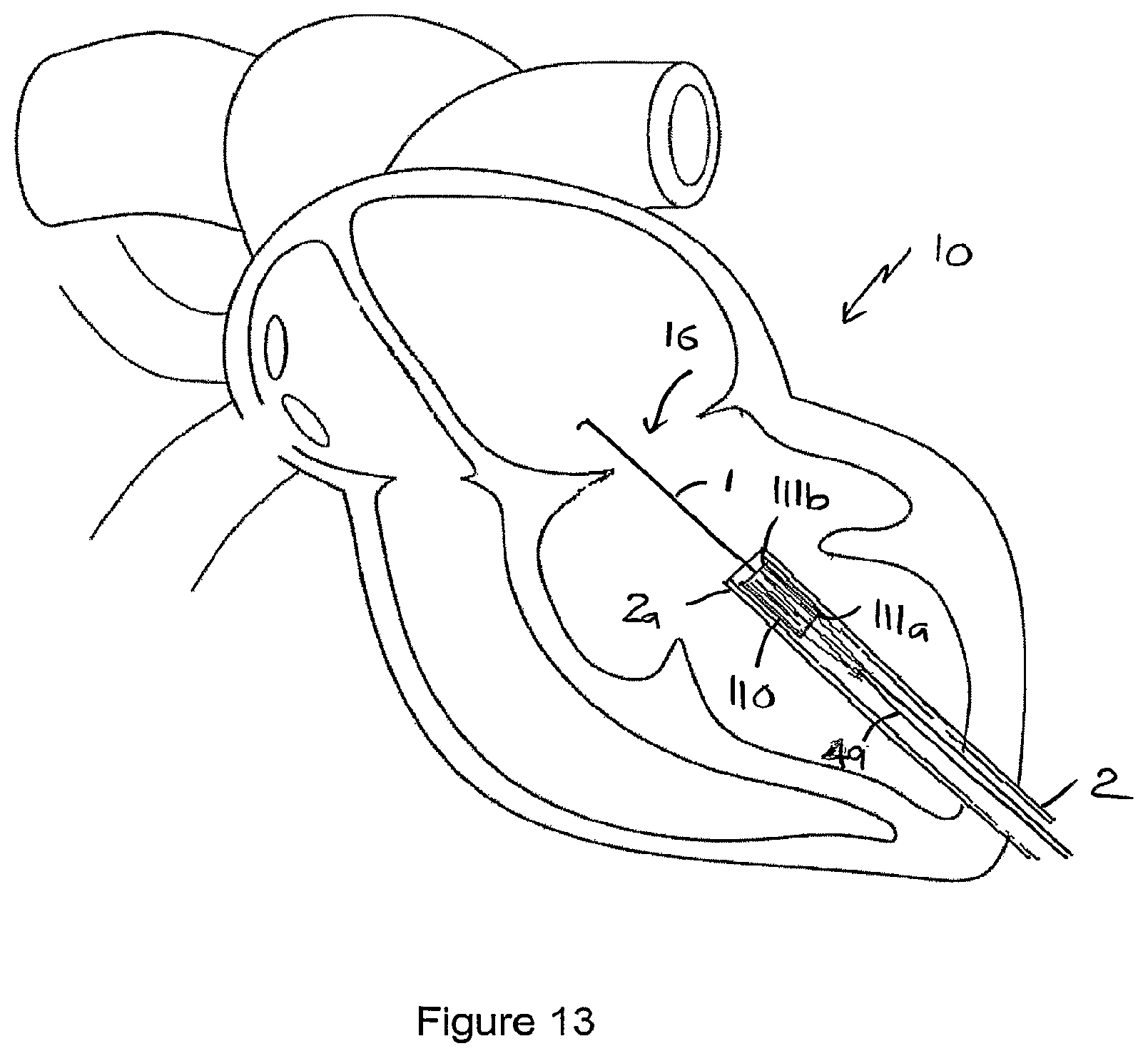 Patent US12551207 Figure 11 – Heart valve prosthesis and method