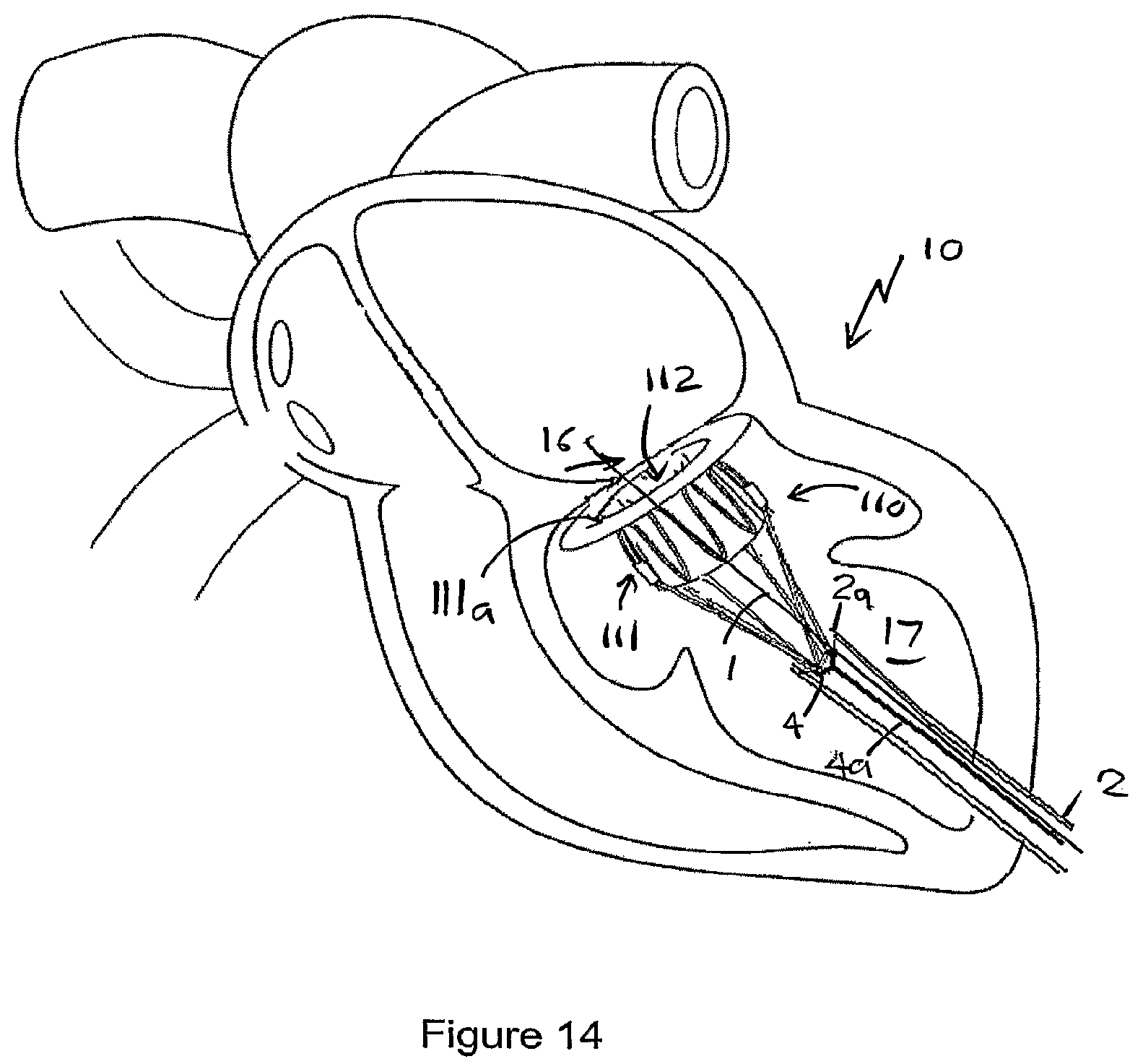 Patent US12551207 Figure 12 – Heart valve prosthesis and method