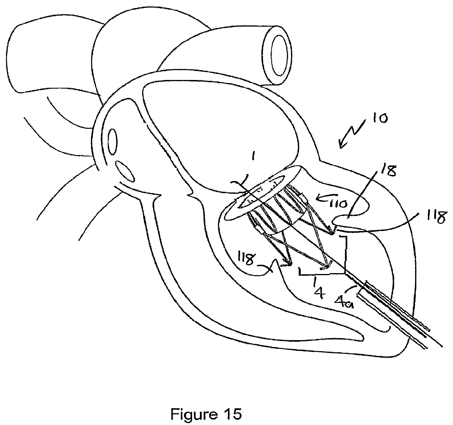 Patent US12551207 Figure 13 – Heart valve prosthesis and method