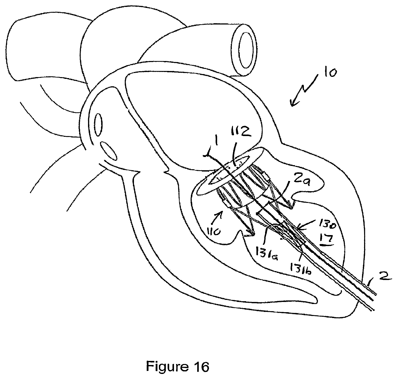 Patent US12551207 Figure 14 – Heart valve prosthesis and method