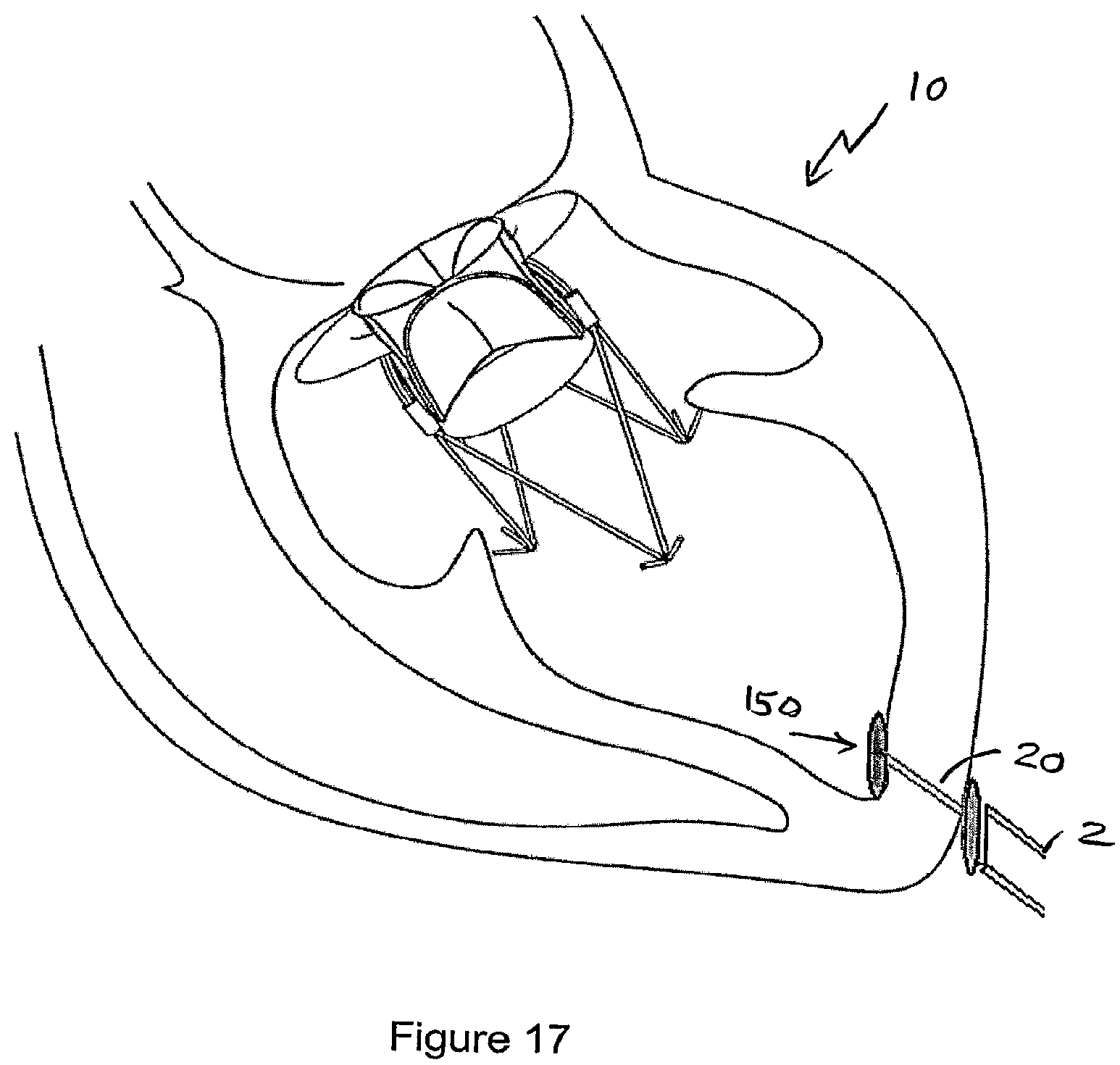 Patent US12551207 Figure 15 – Heart valve prosthesis and method