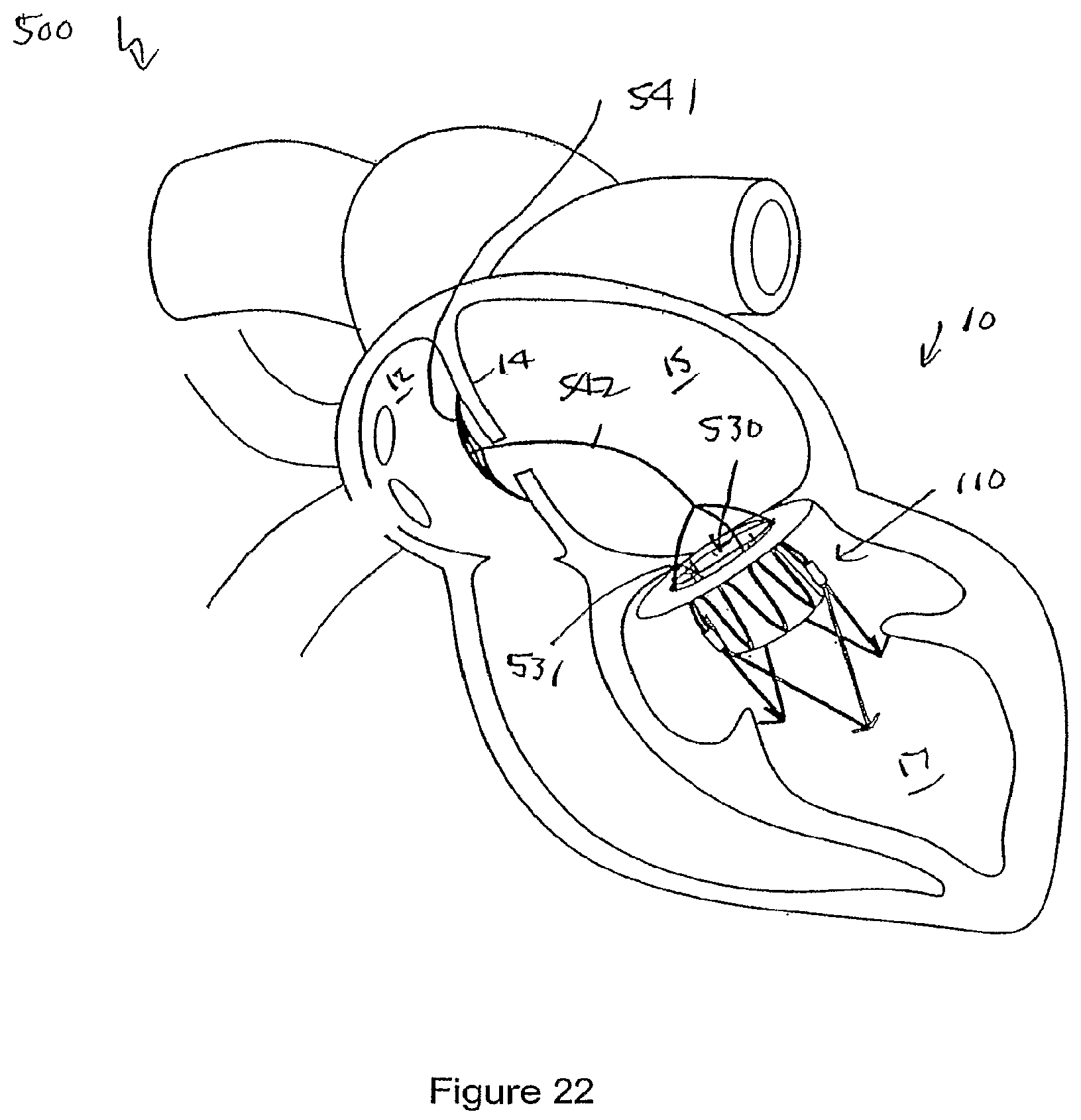 Patent US12551207 Figure 19 – Heart valve prosthesis and method