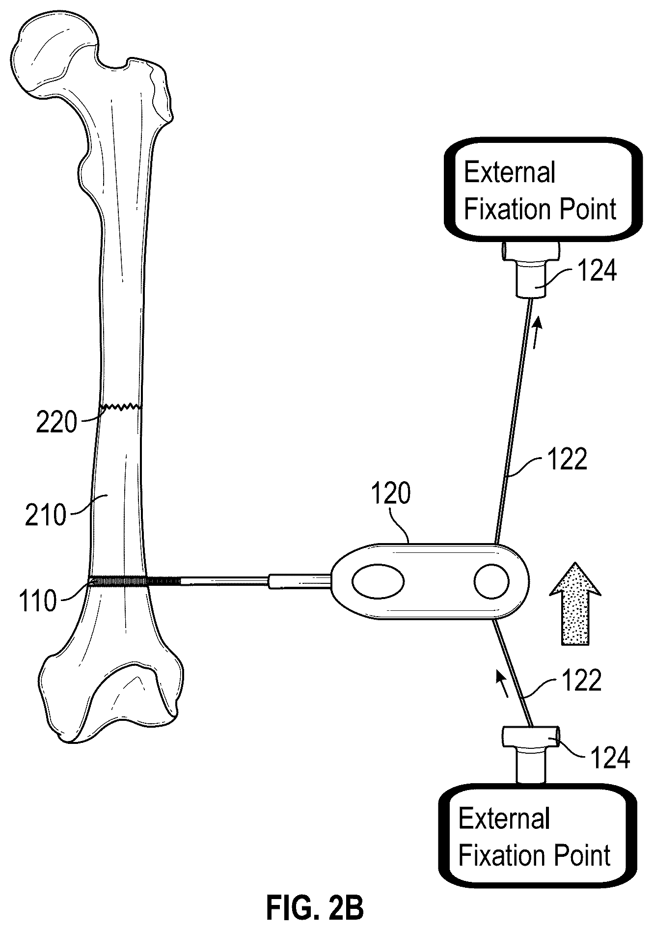 Patent US12551208 Figure 3 – Self-retaining bone holding devices and methods