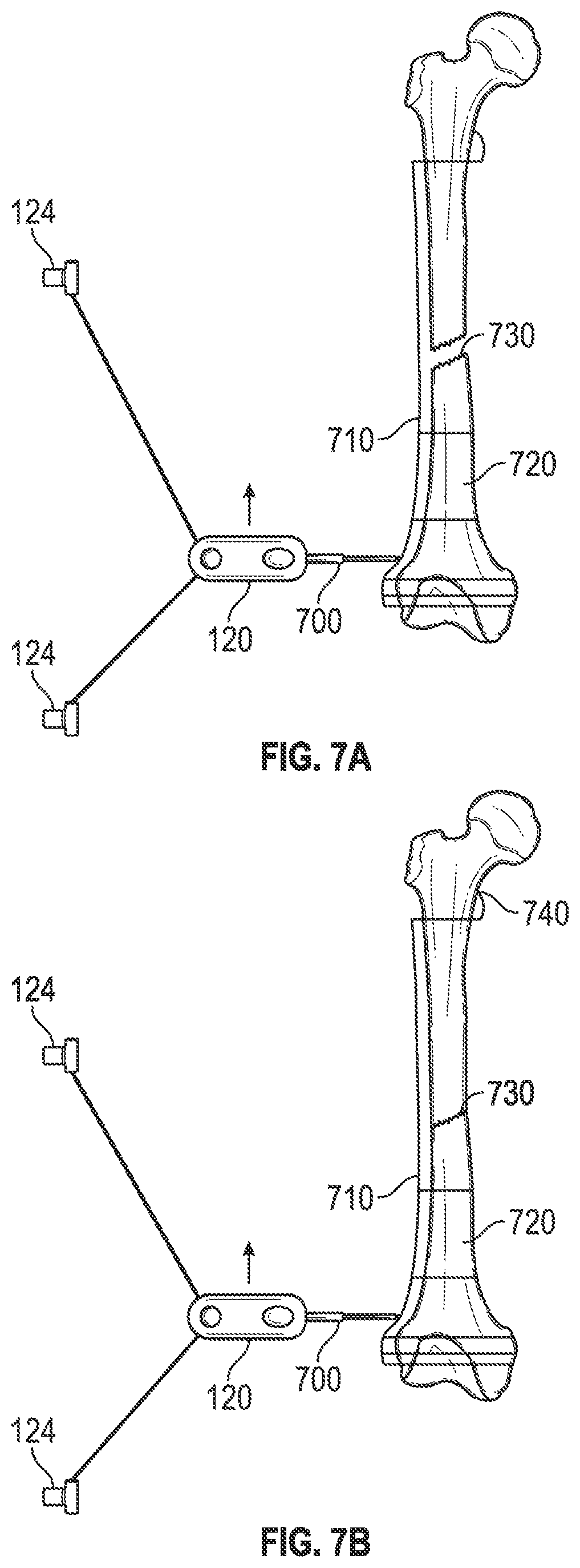 Patent US12551208 Figure 8 – Self-retaining bone holding devices and methods
