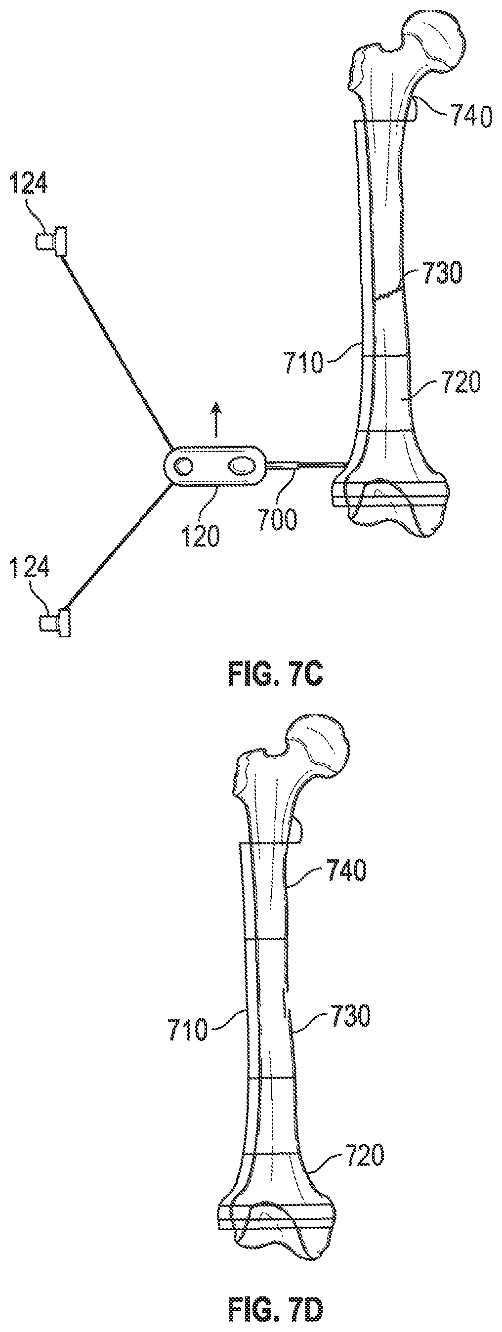 Patent US12551208 Figure 9 – Self-retaining bone holding devices and methods